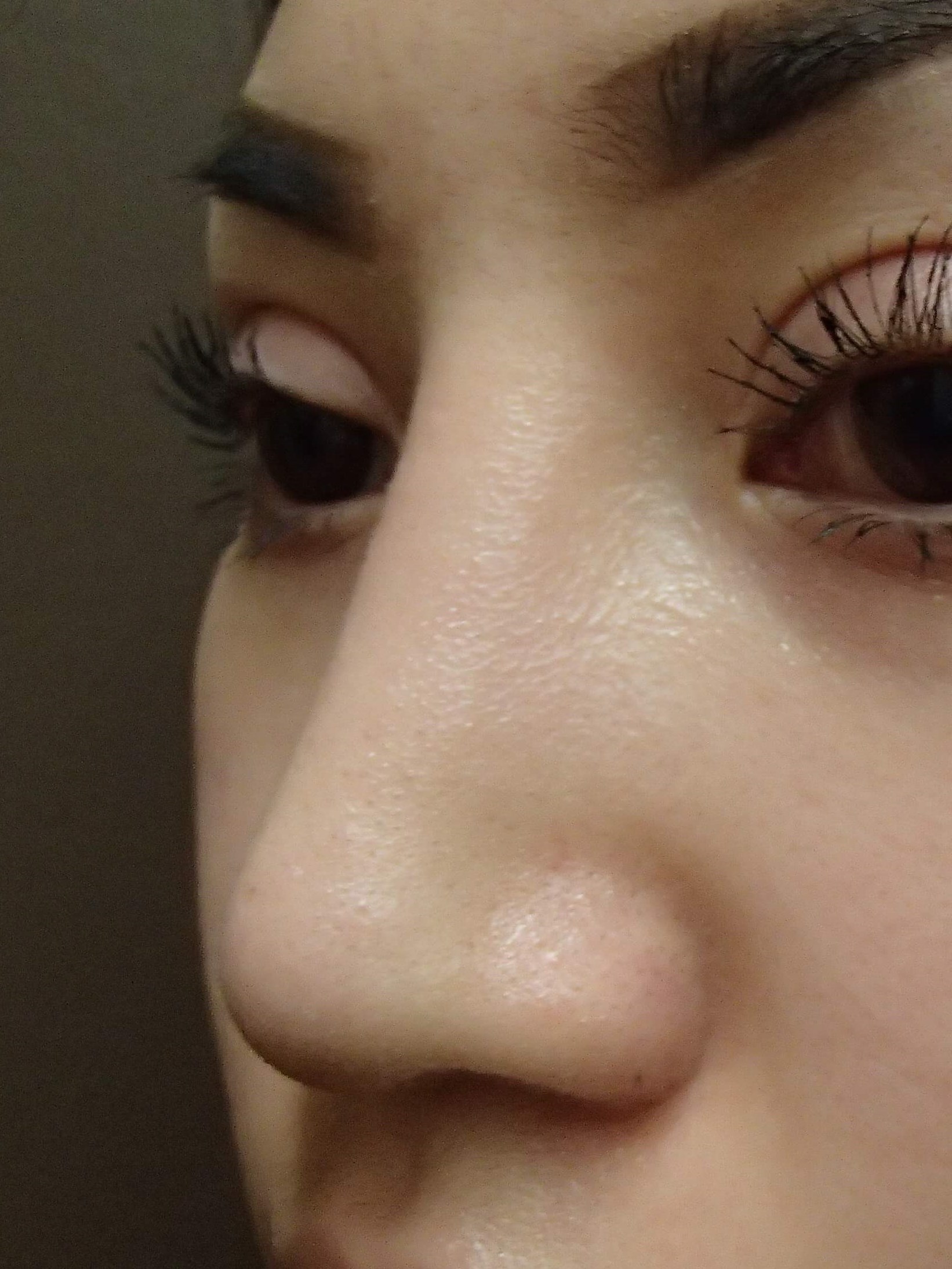 Rhinoplasty with Implant After