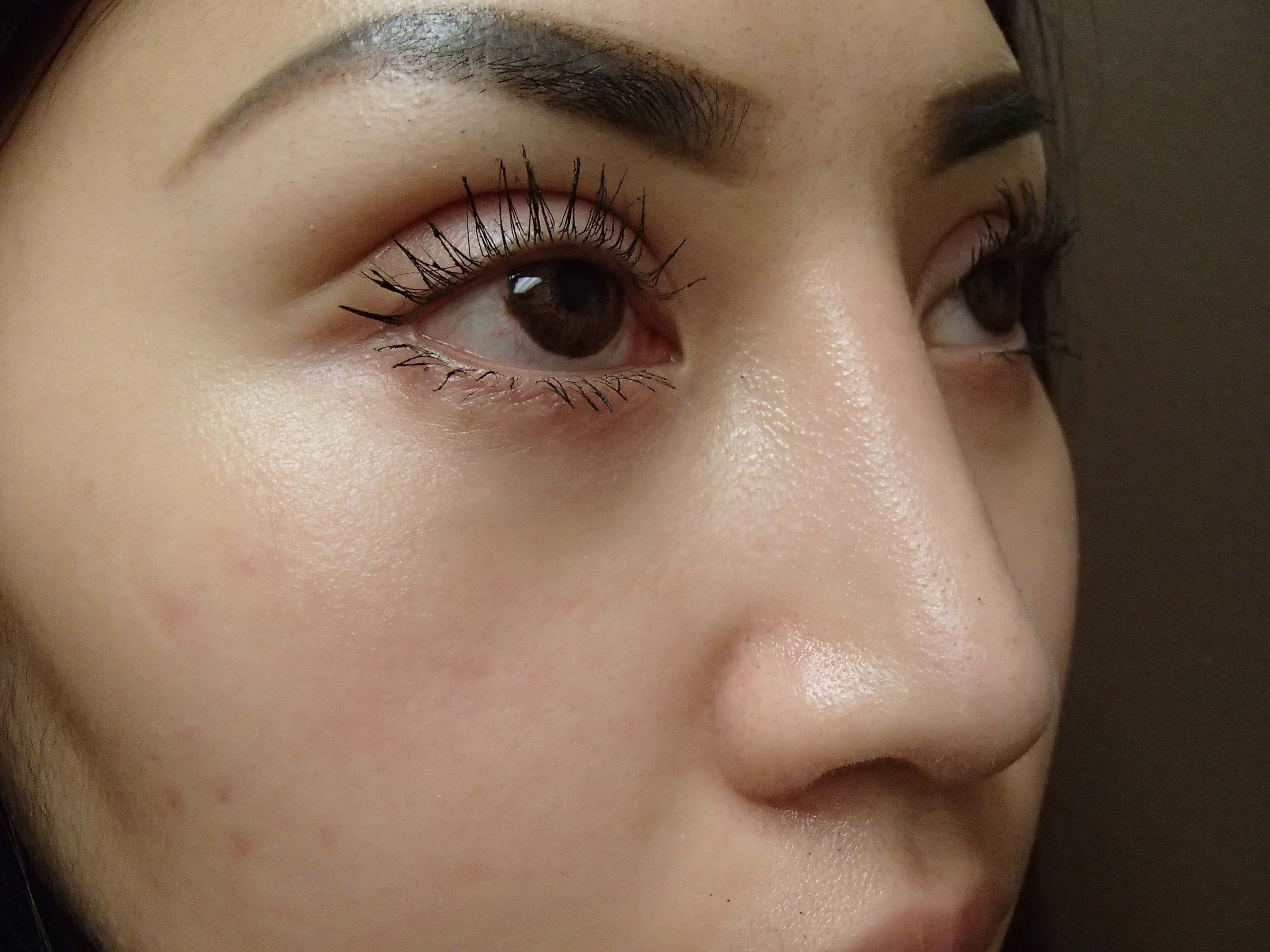 Rhinoplasty with Implant After