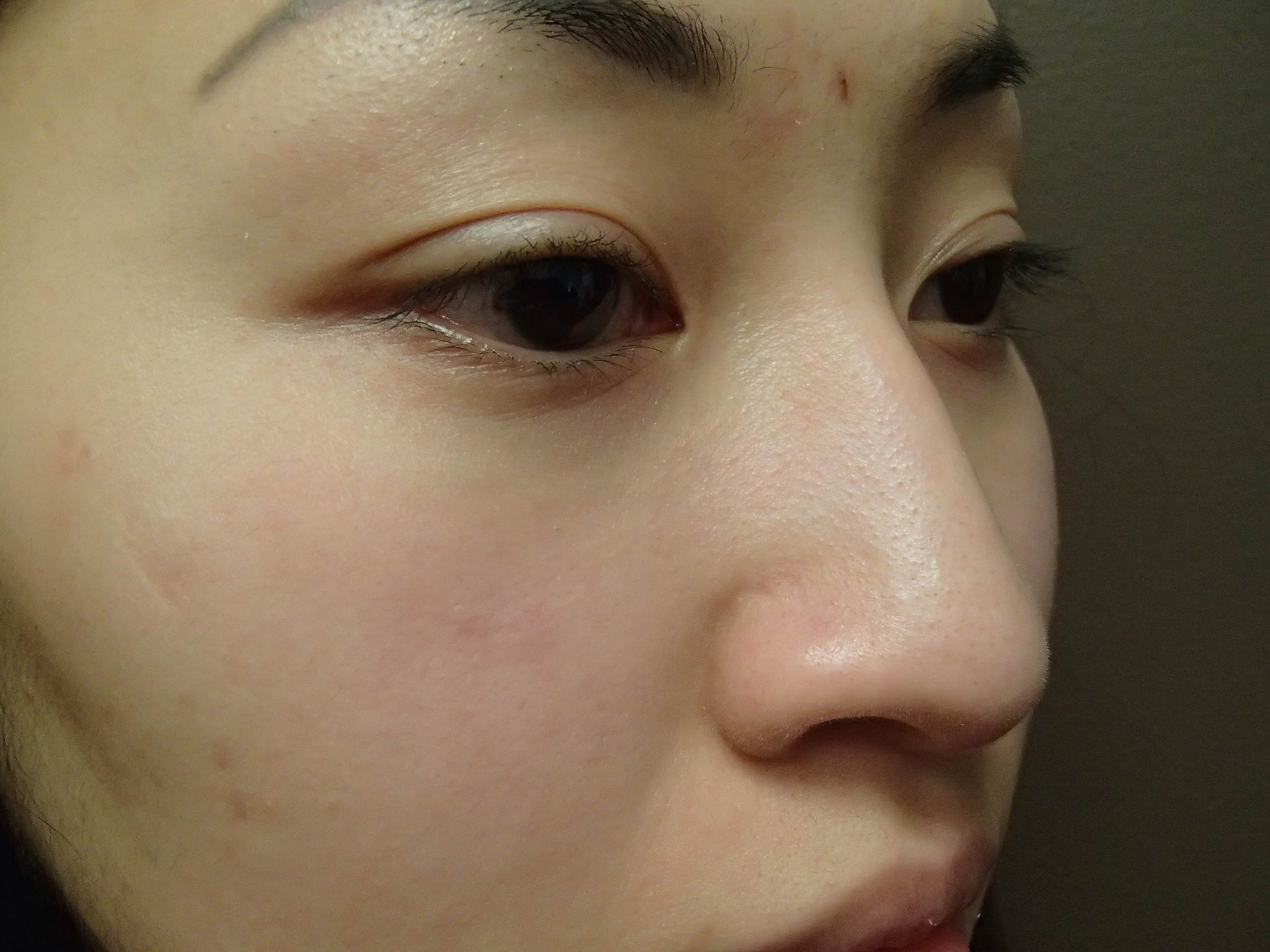 Rhinoplasty with Implant Before