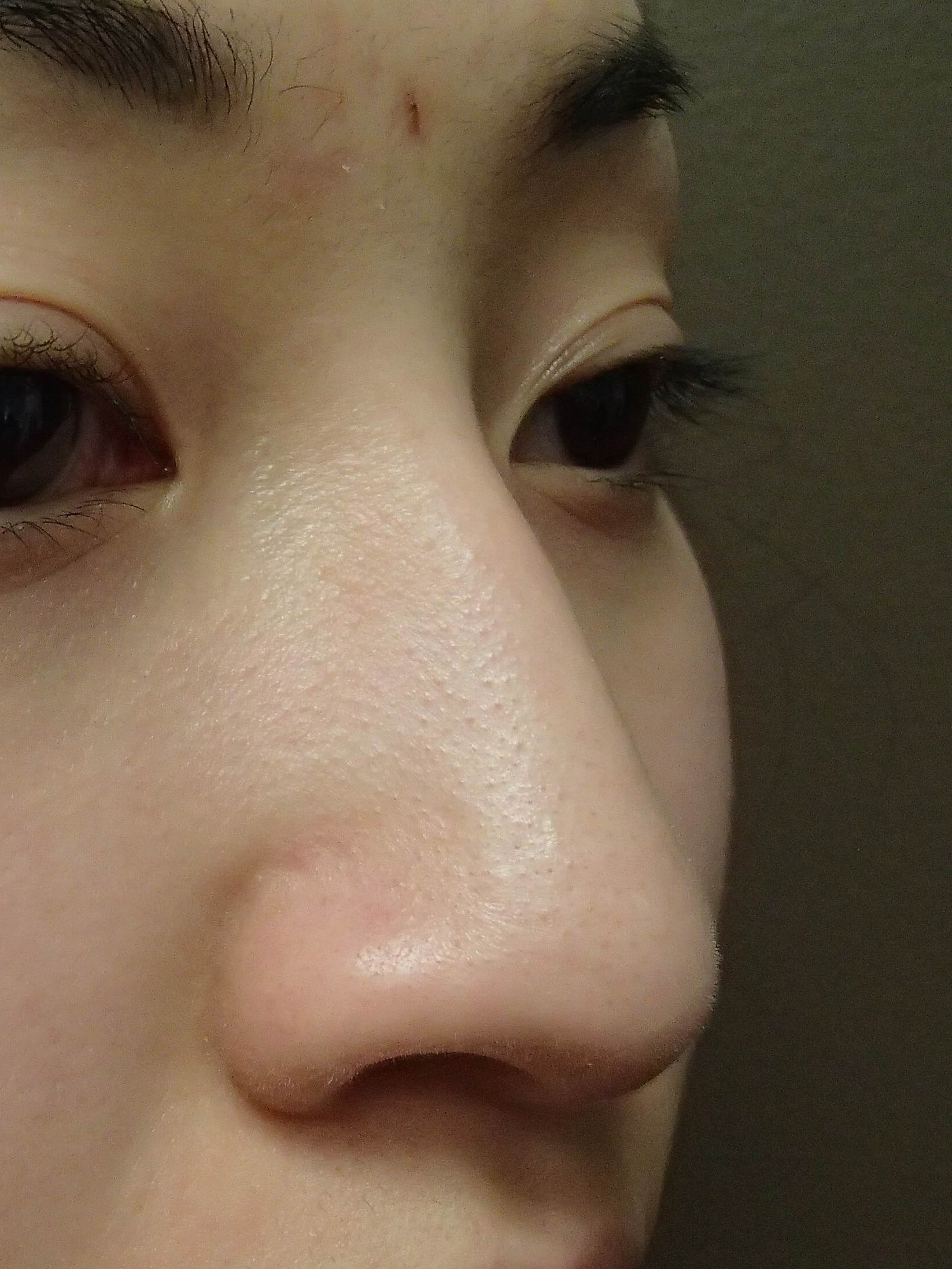 Rhinoplasty with Implant Before