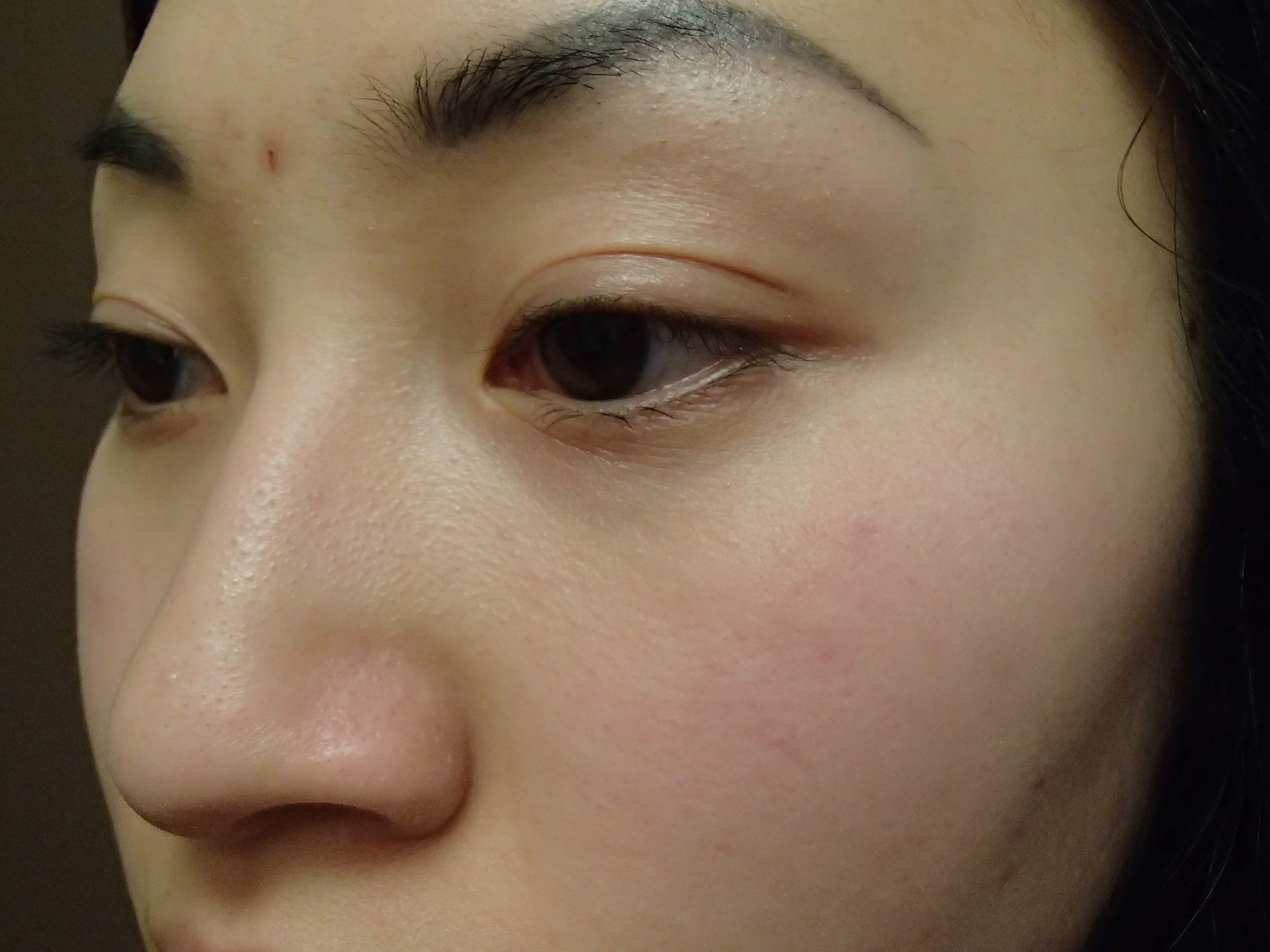 Rhinoplasty with Implant Before