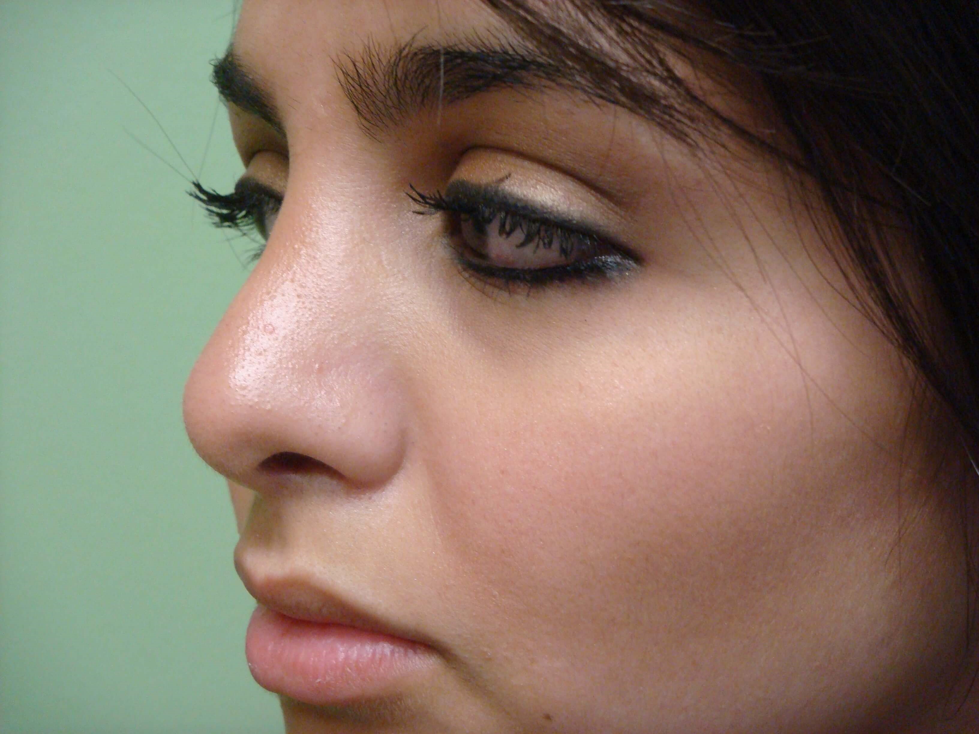 Rhinoplasty (nose job) After