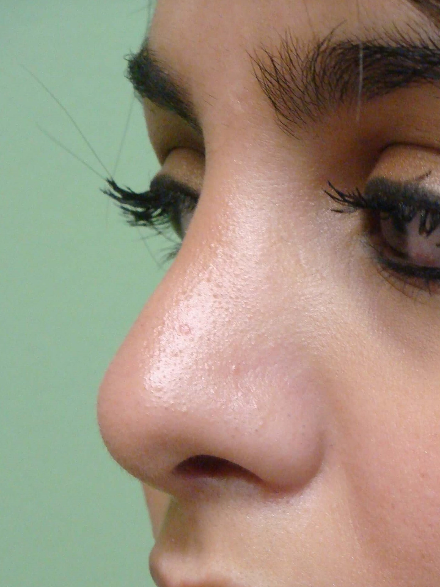 Rhinoplasty (nose job) After