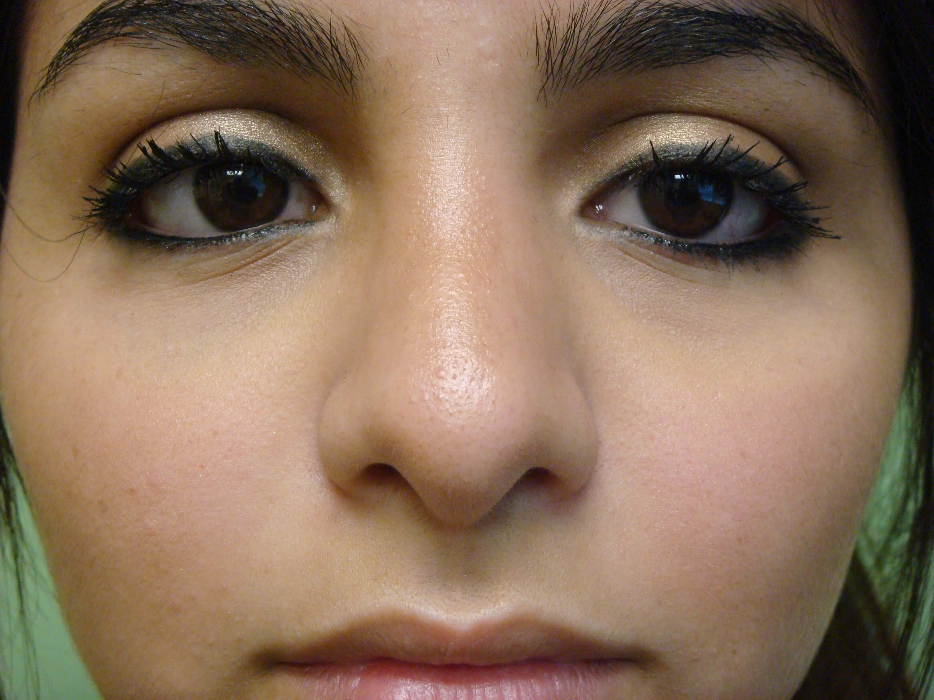 Rhinoplasty (nose job) After