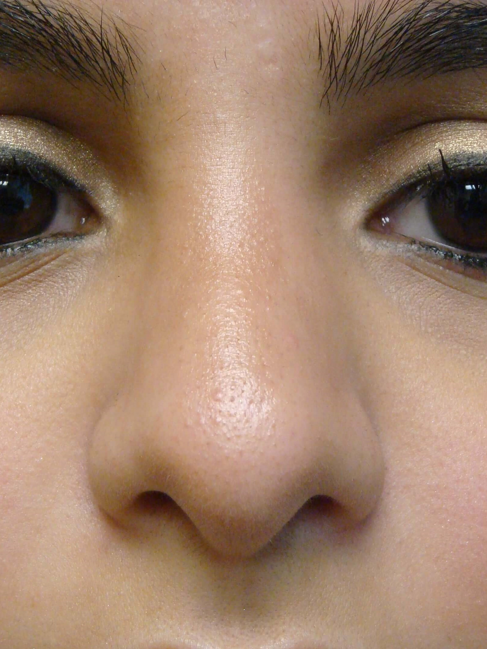 Rhinoplasty (nose job) After