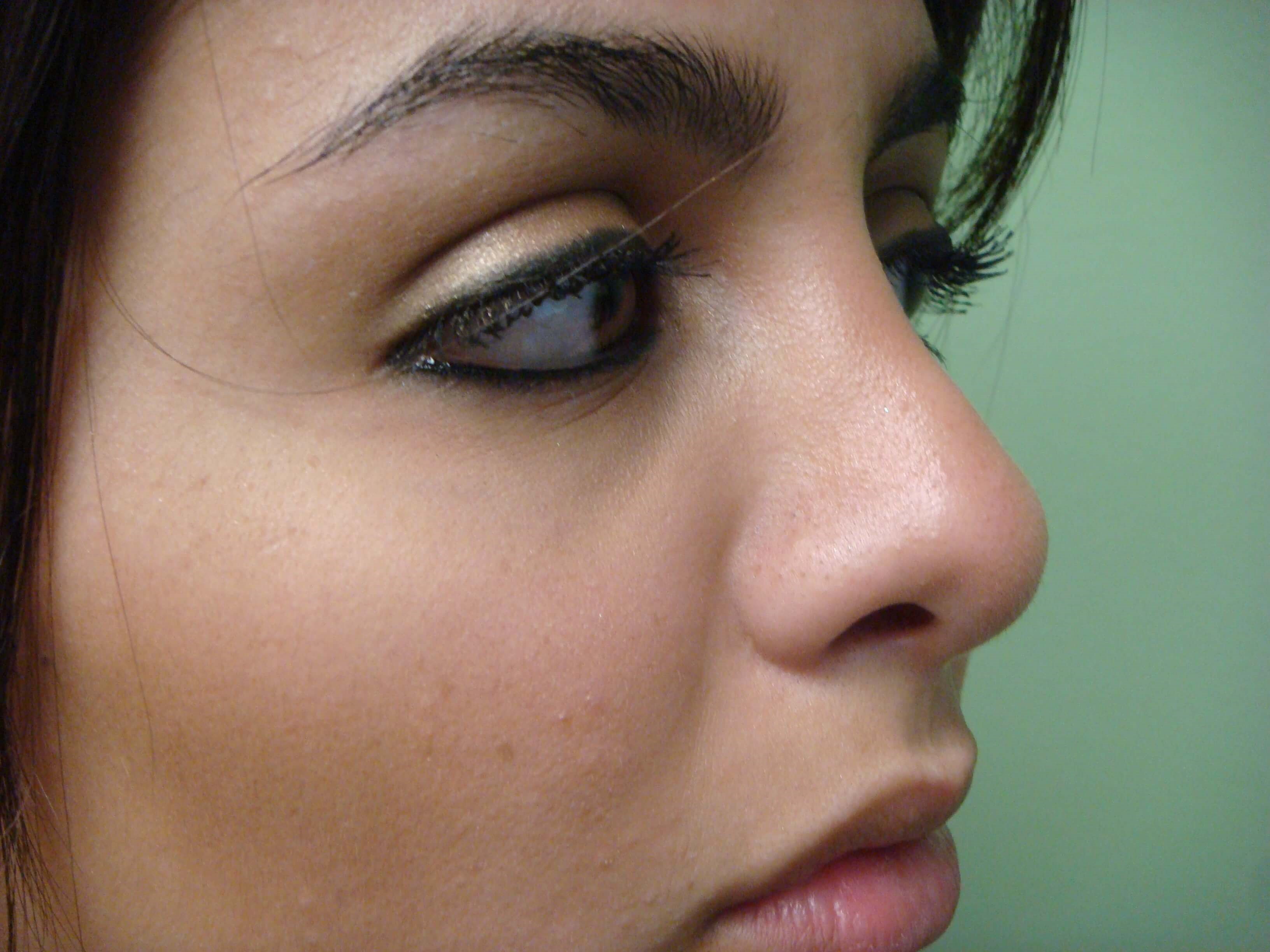 Rhinoplasty (nose job) After