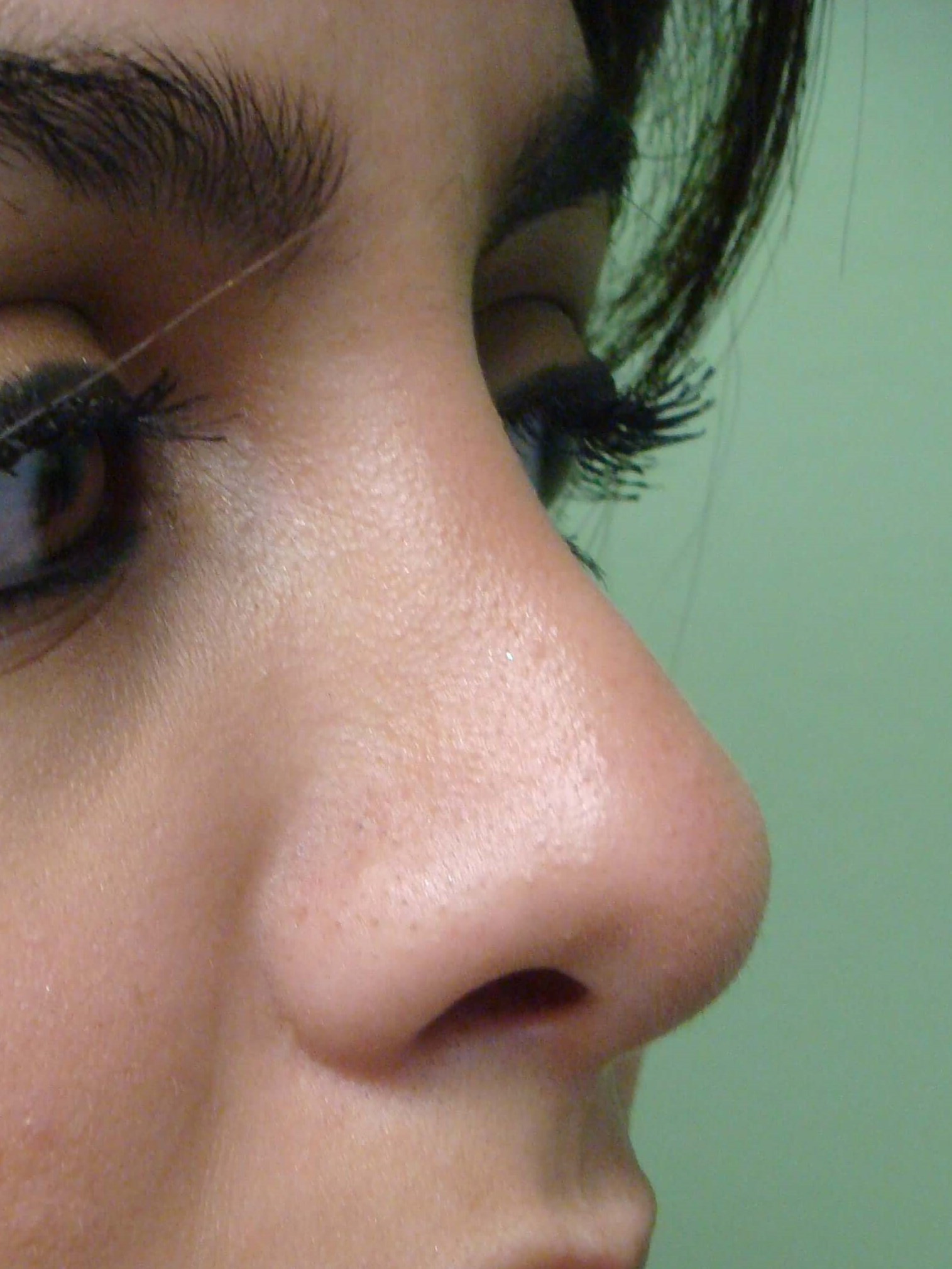 Rhinoplasty (nose job) After