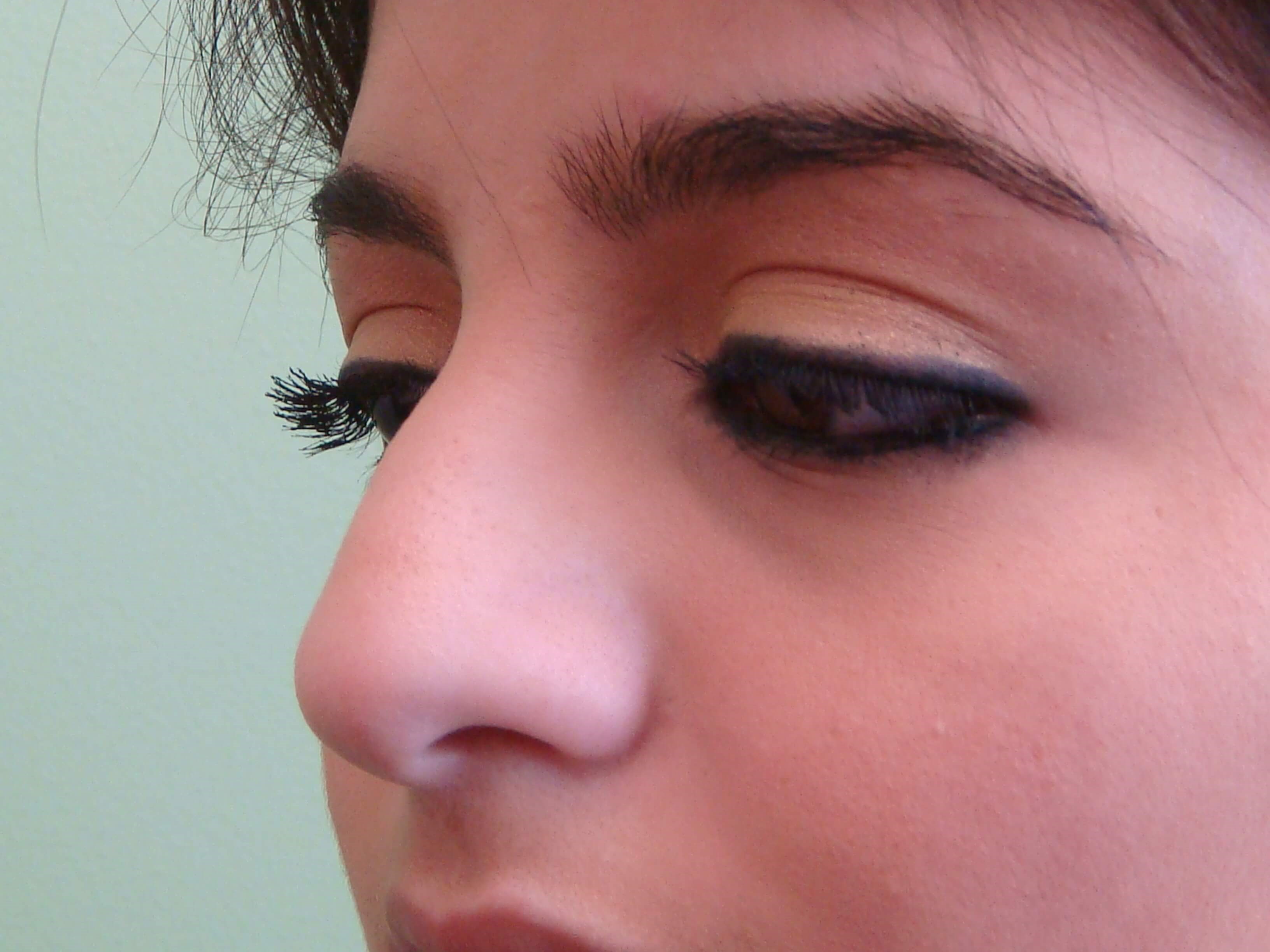 Rhinoplasty (nose job) Before