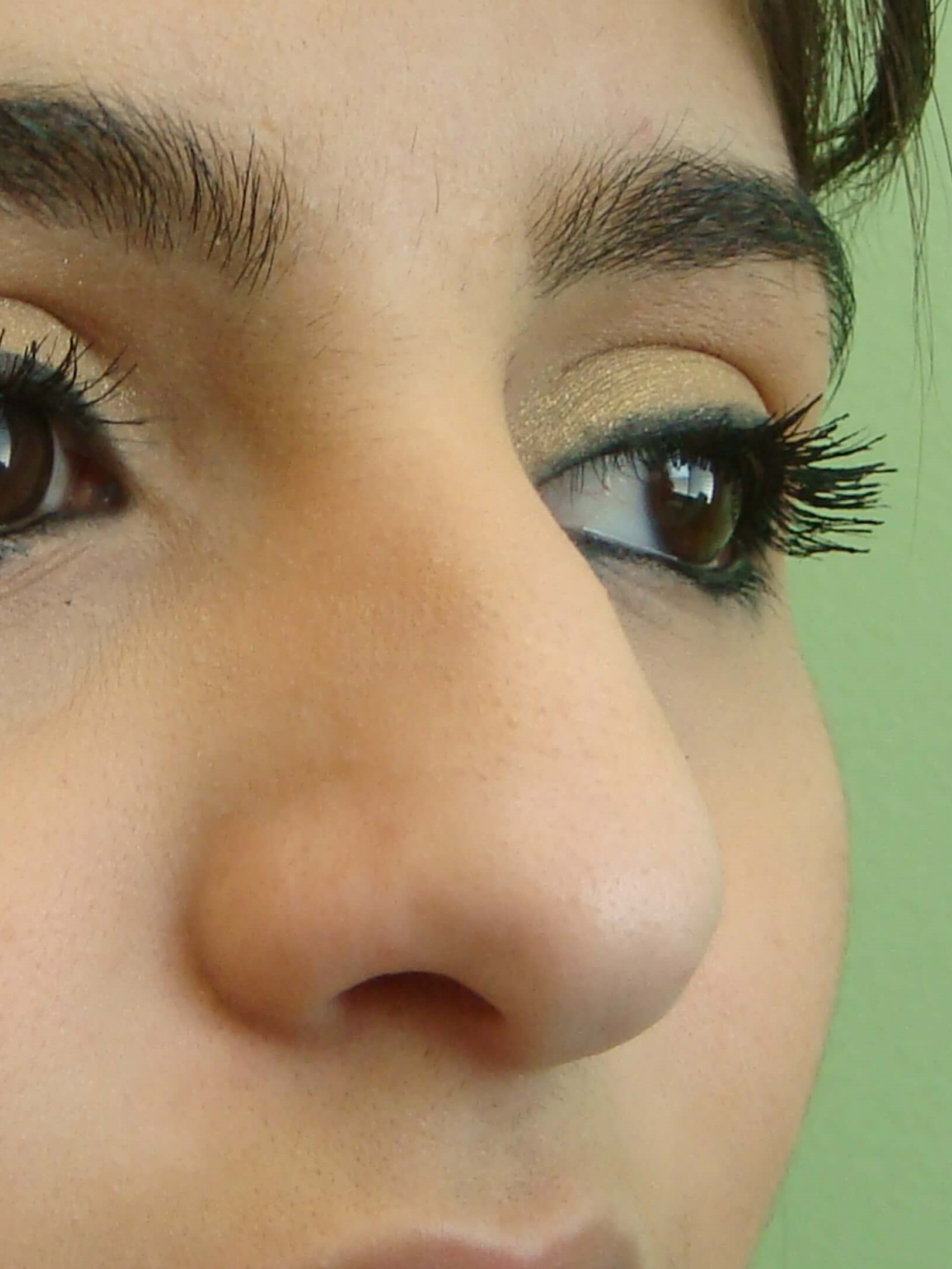 Rhinoplasty (nose job) Before