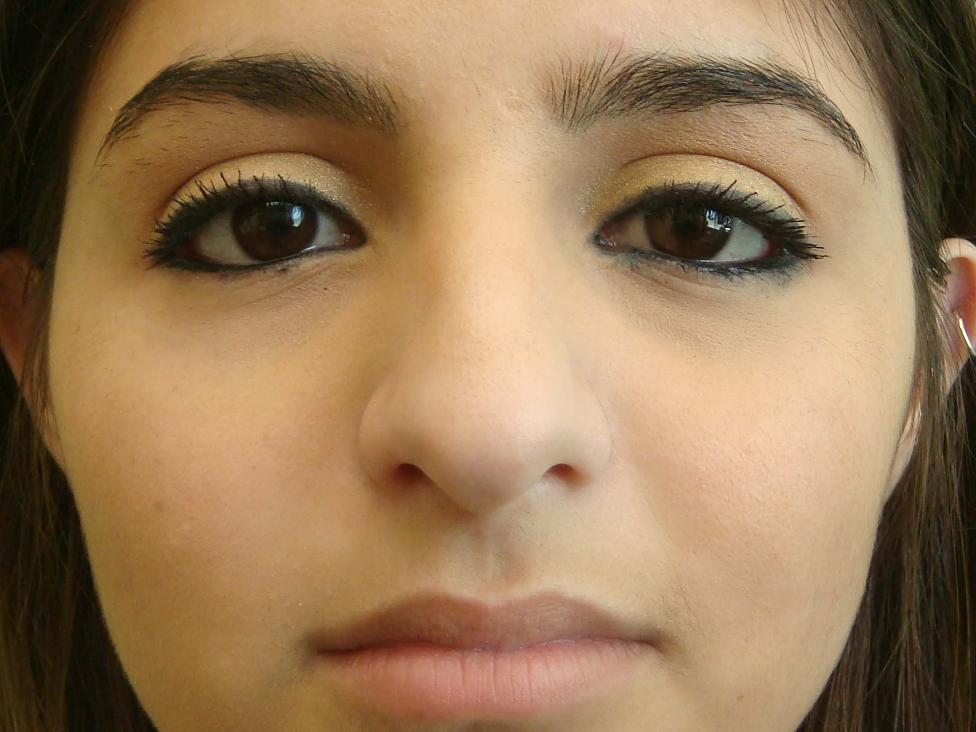 Rhinoplasty (nose job) Before