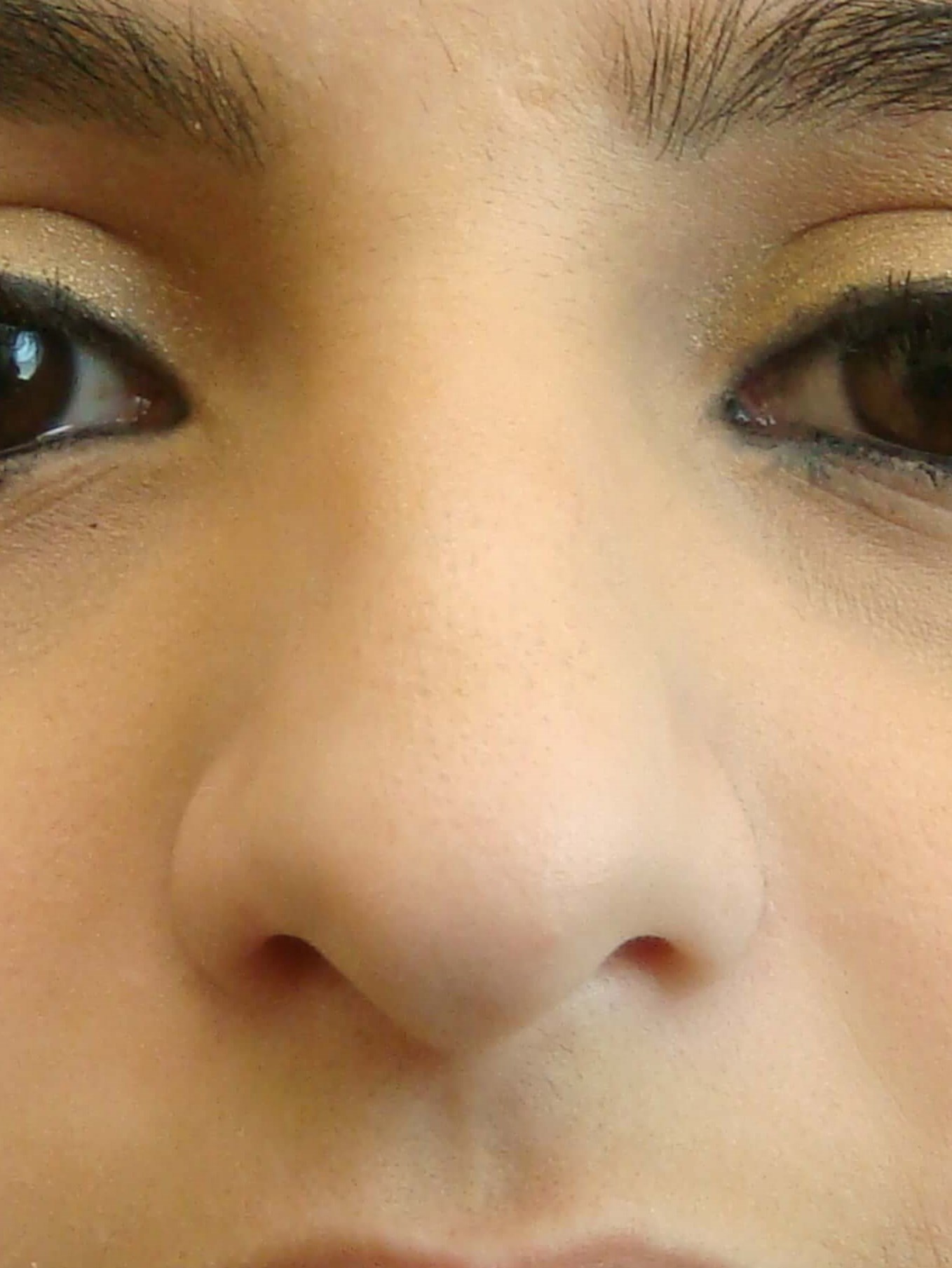 Rhinoplasty (nose job) Before