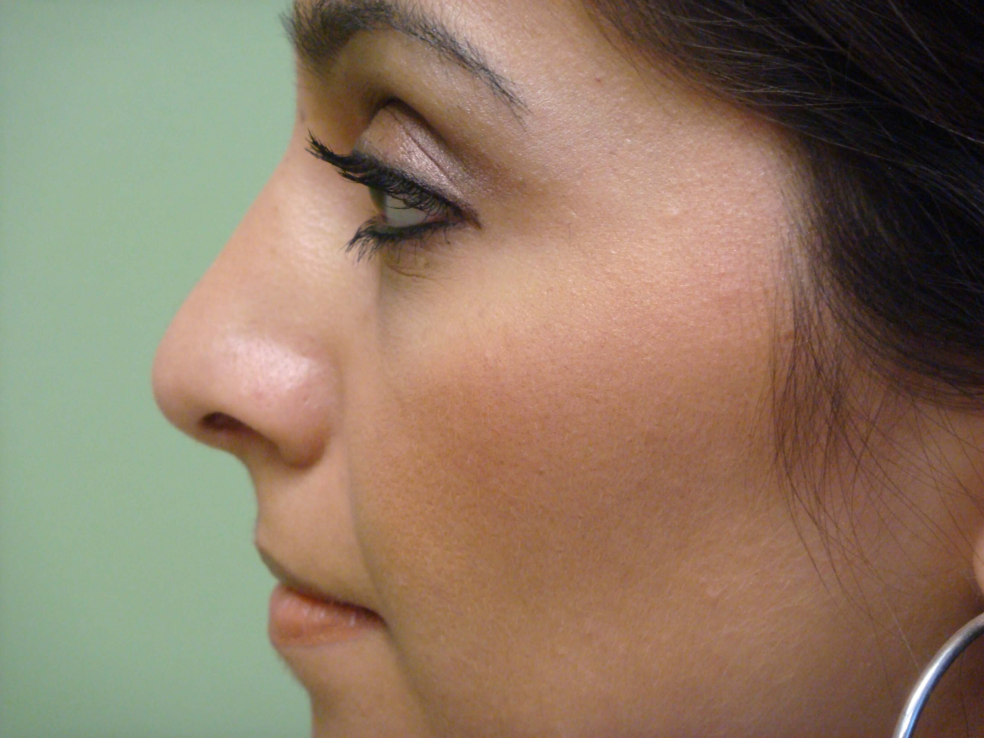 Rhinoplasty (nose job) After