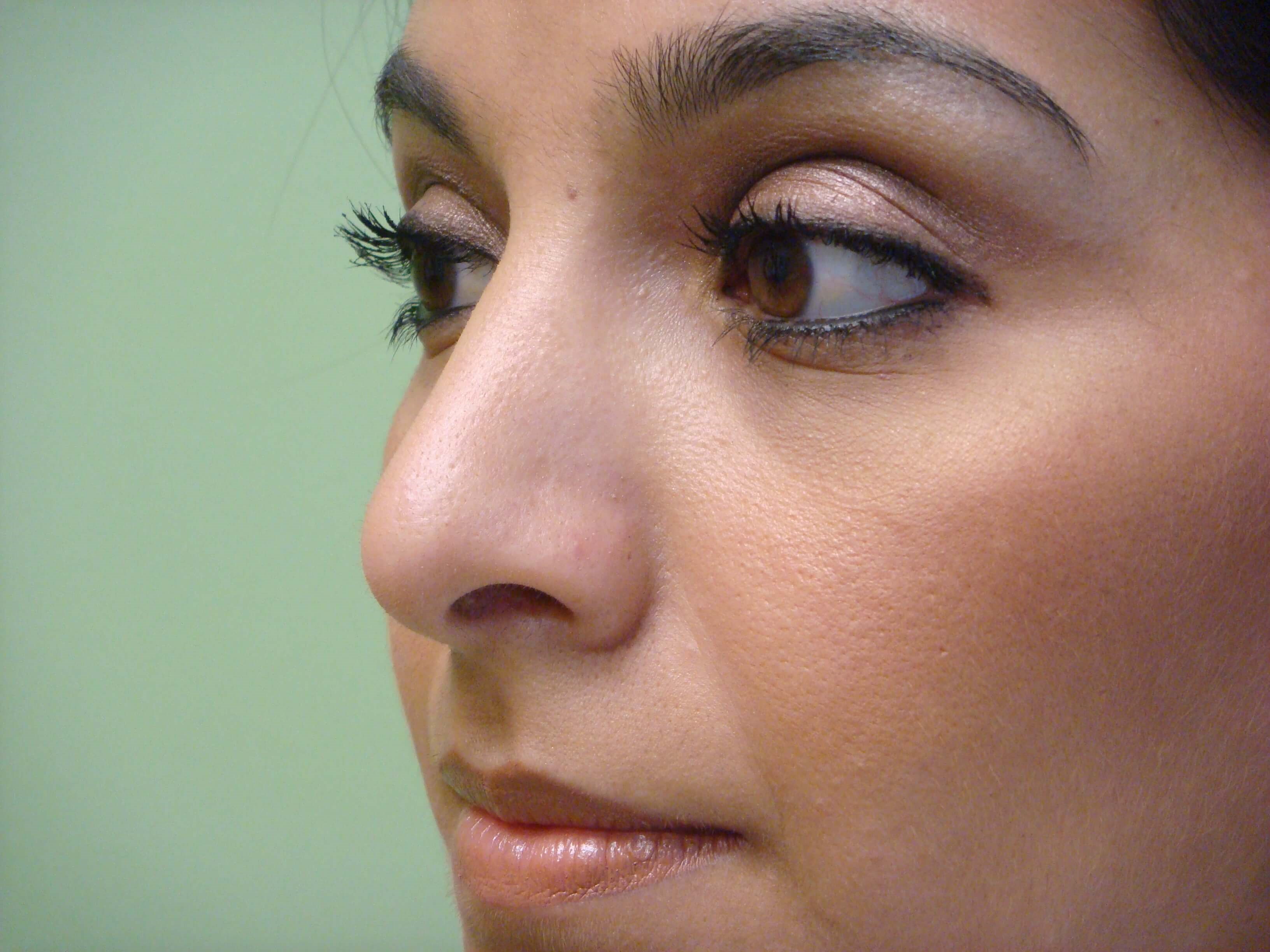 Rhinoplasty (nose job) After