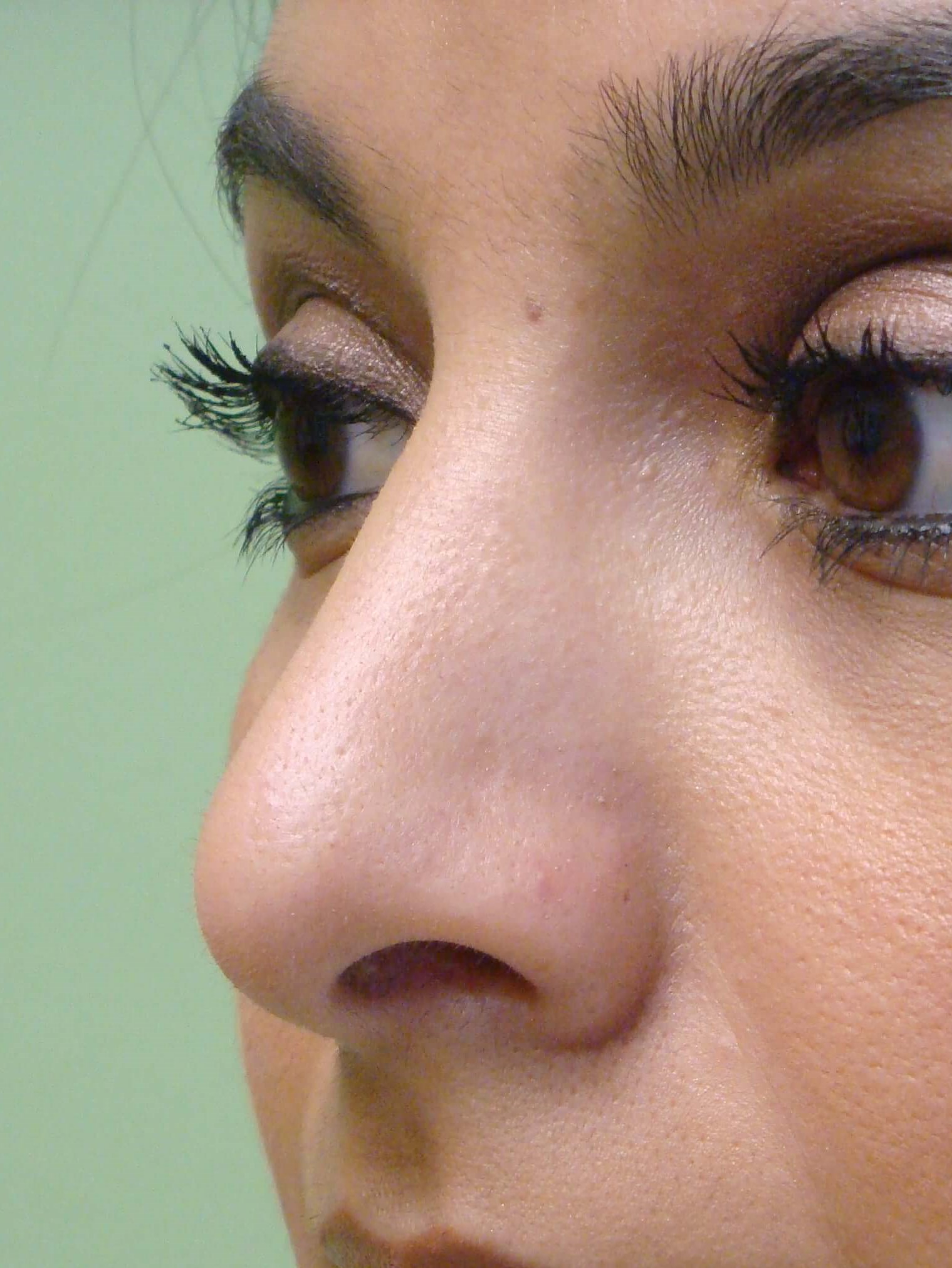 Rhinoplasty (nose job) After