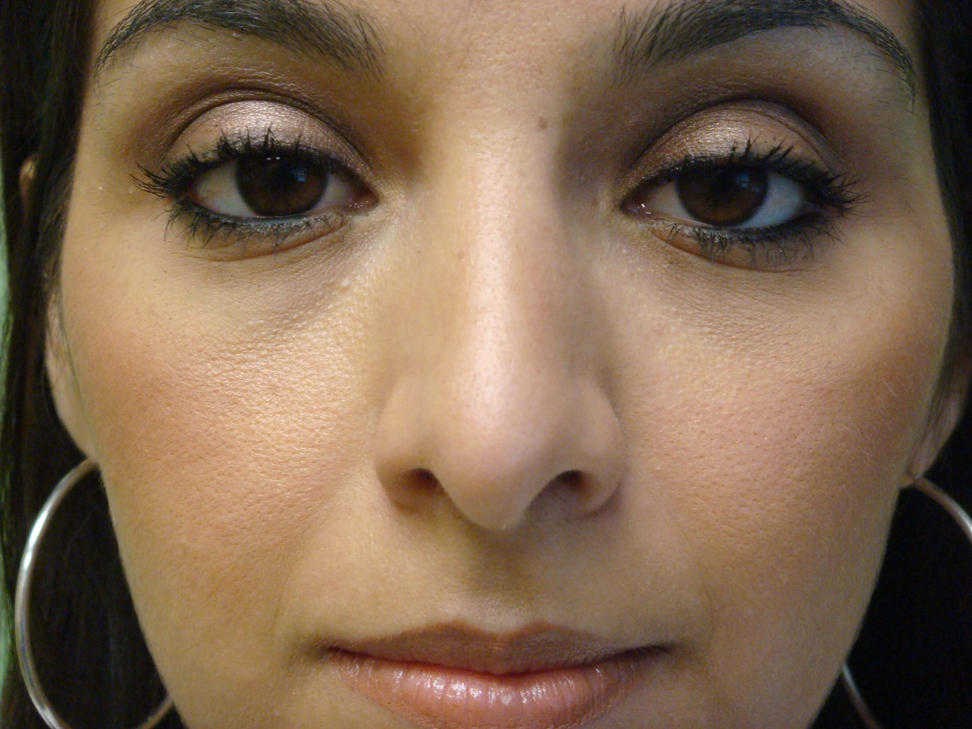 Rhinoplasty (nose job) After