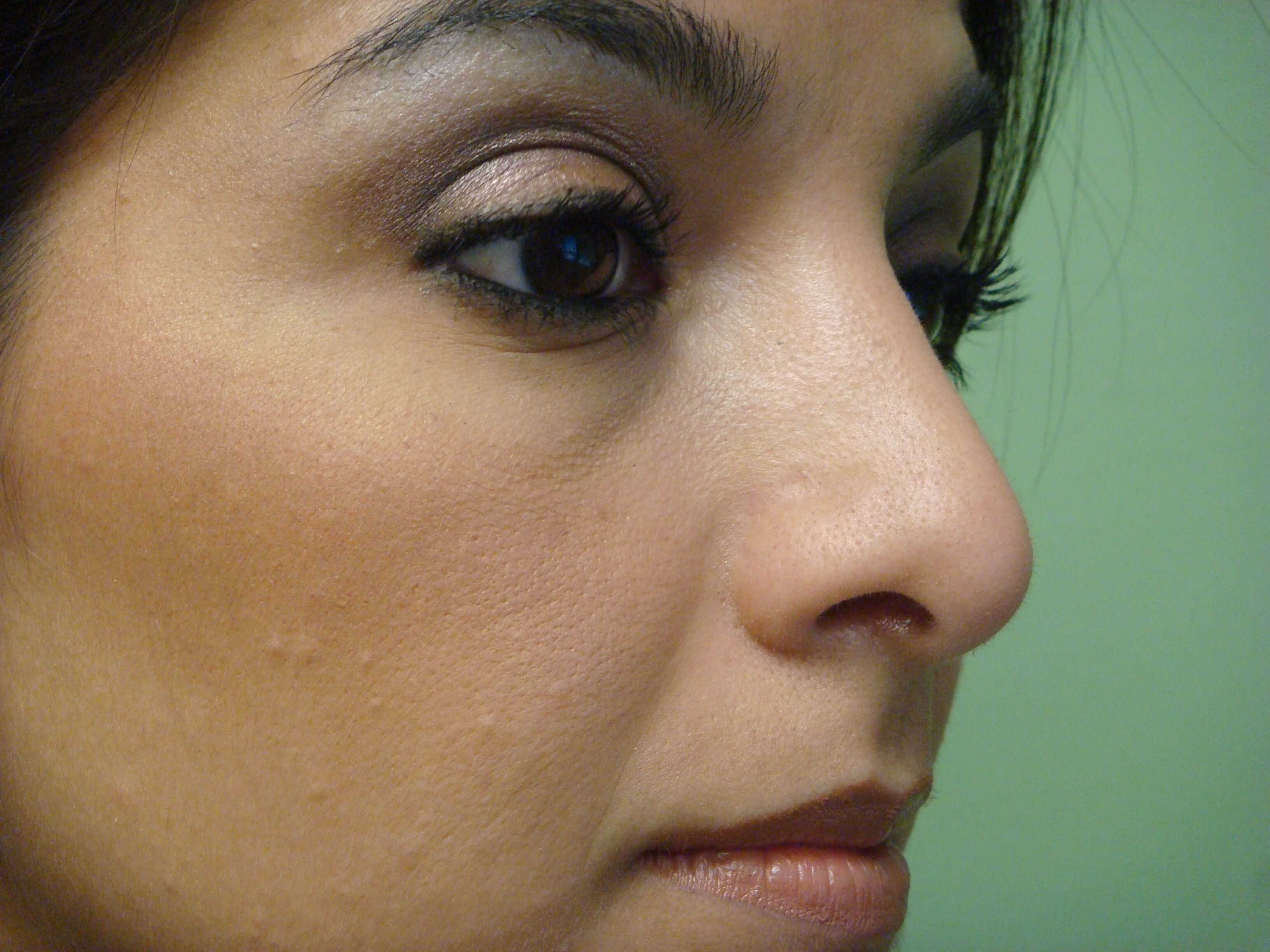 Rhinoplasty (nose job) After