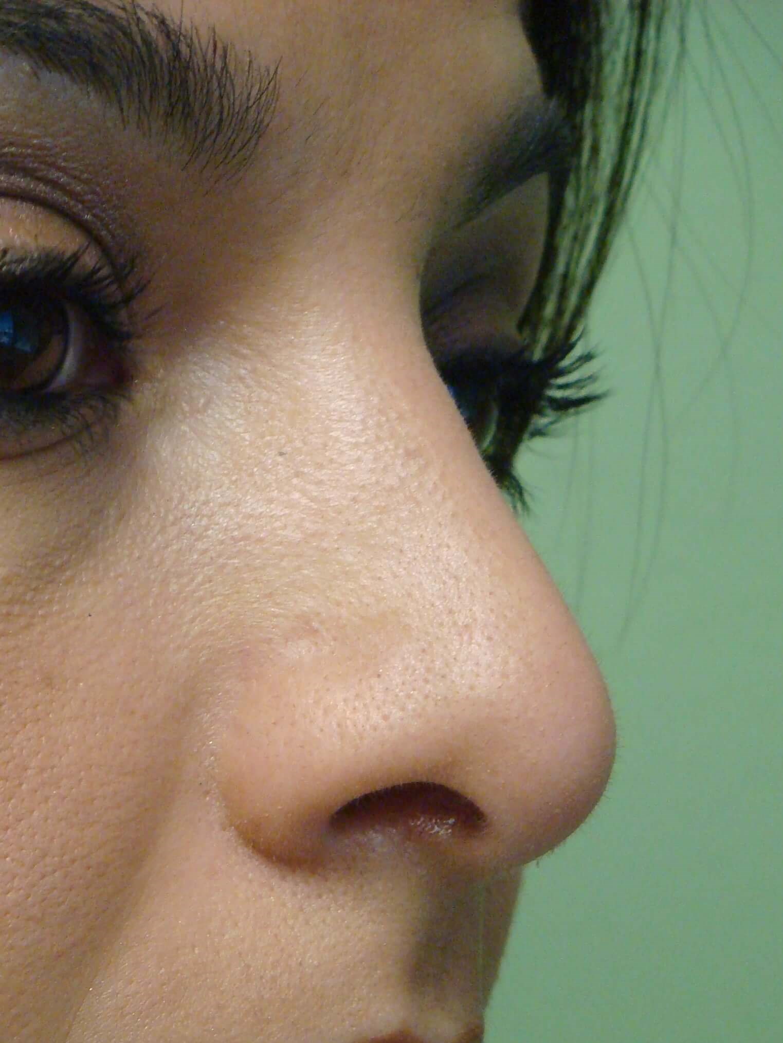 Rhinoplasty (nose job) After