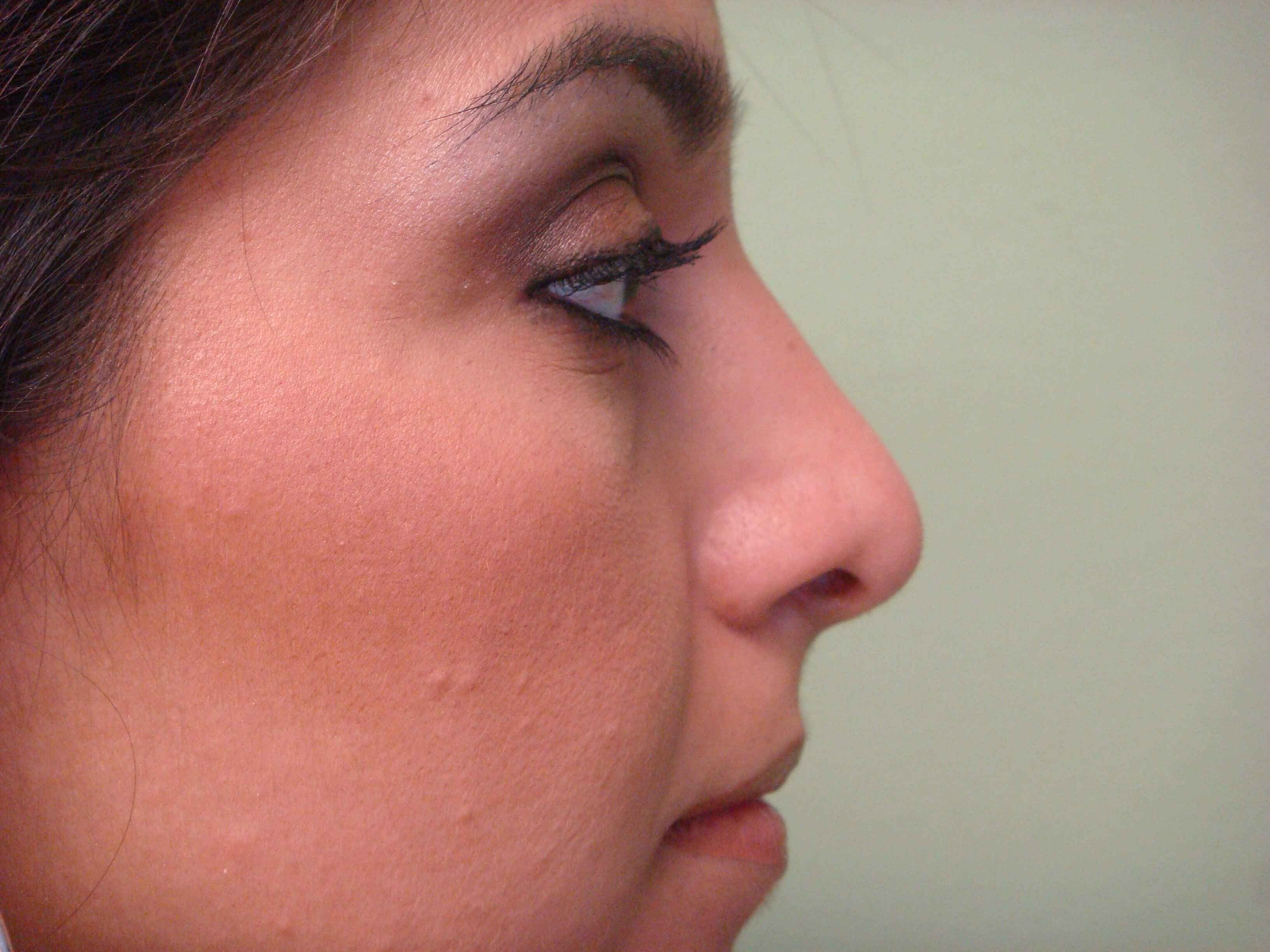 Rhinoplasty (nose job) After