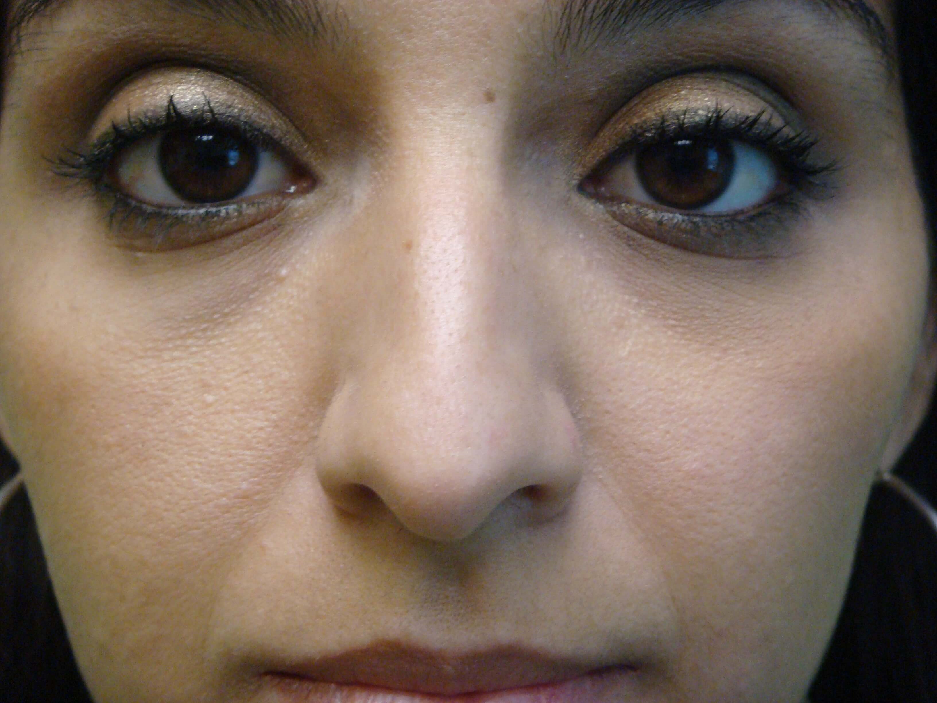 Rhinoplasty (nose job) Before