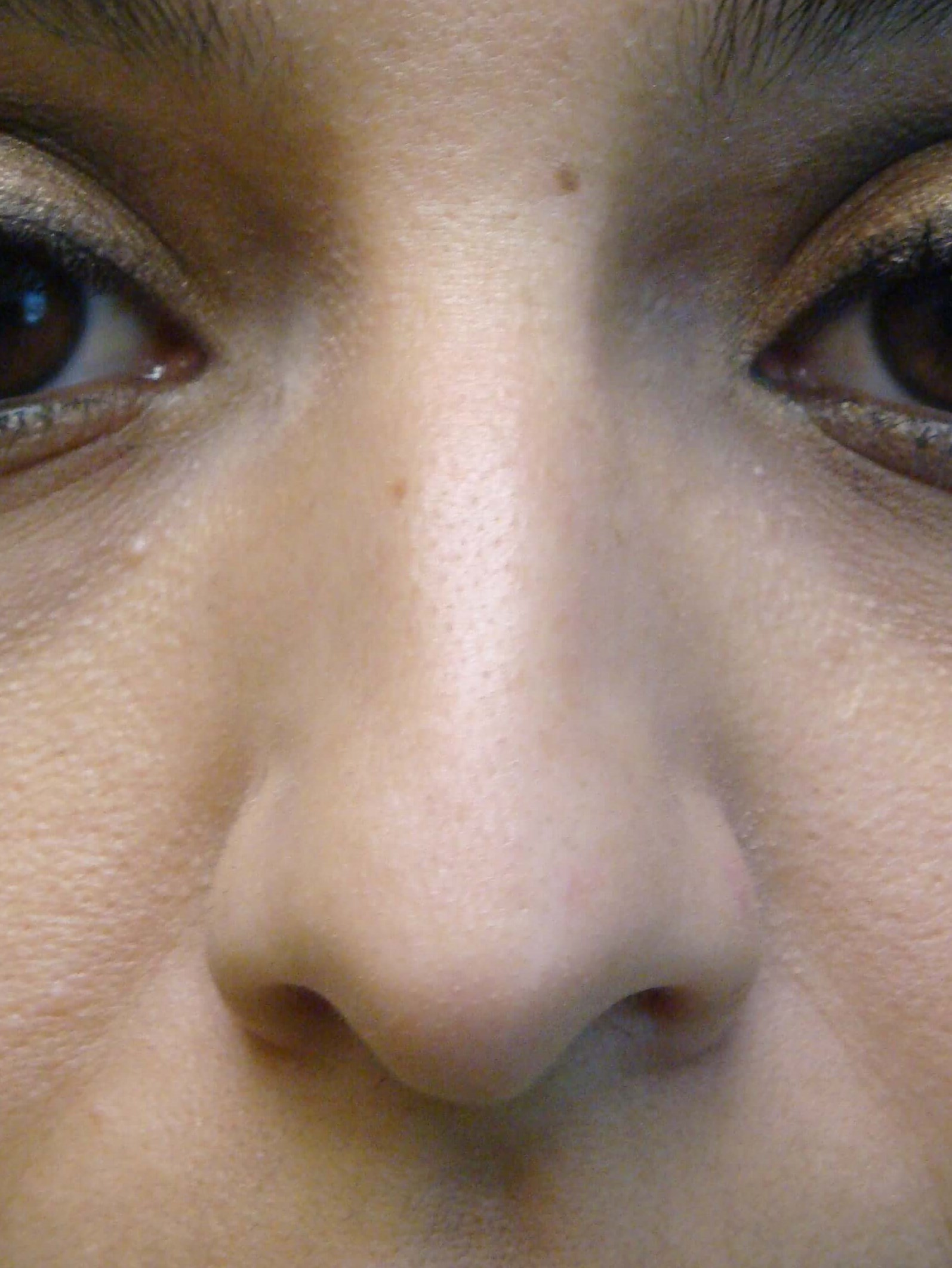 Rhinoplasty (nose job) Before