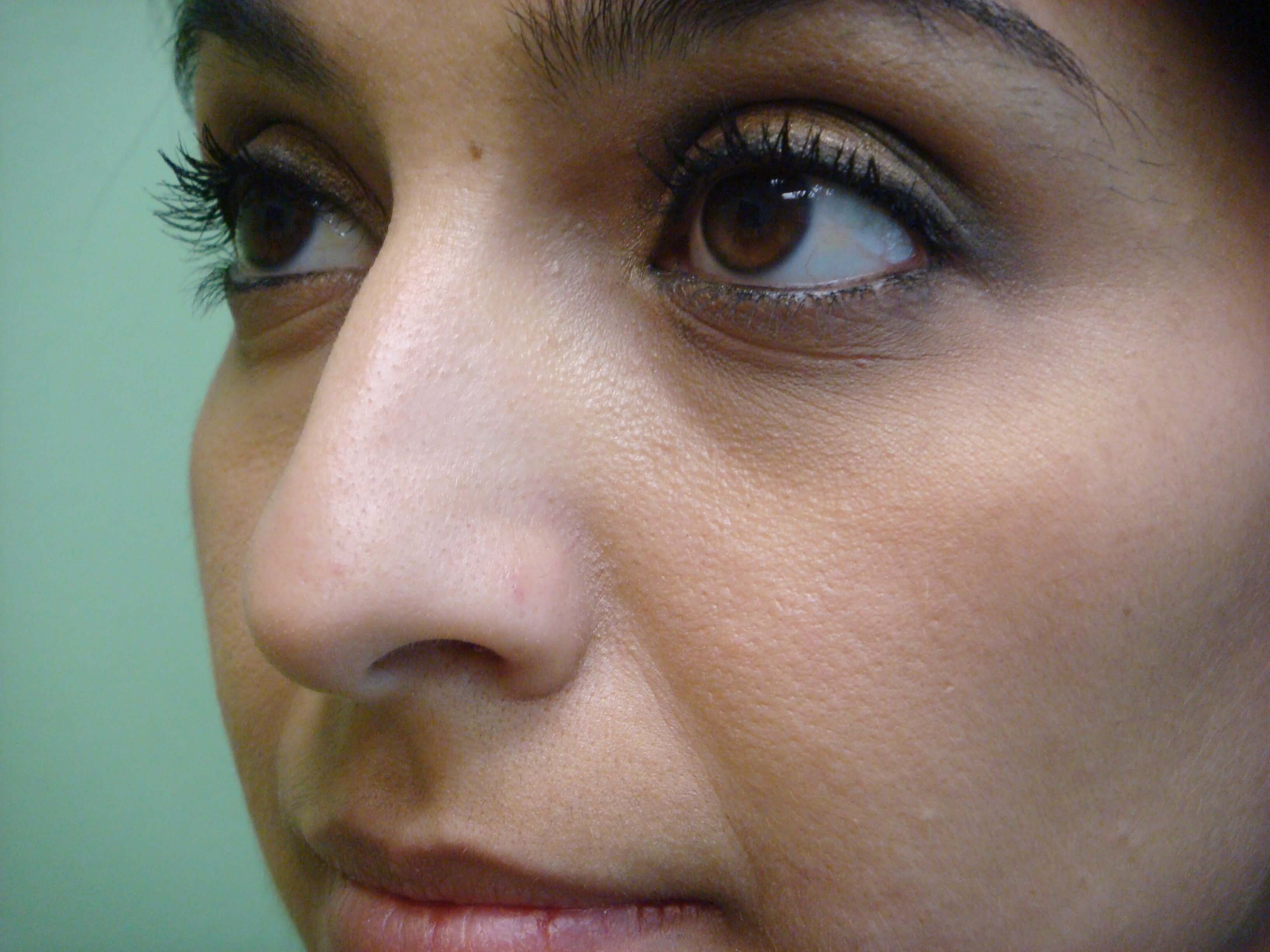 Rhinoplasty (nose job) Before