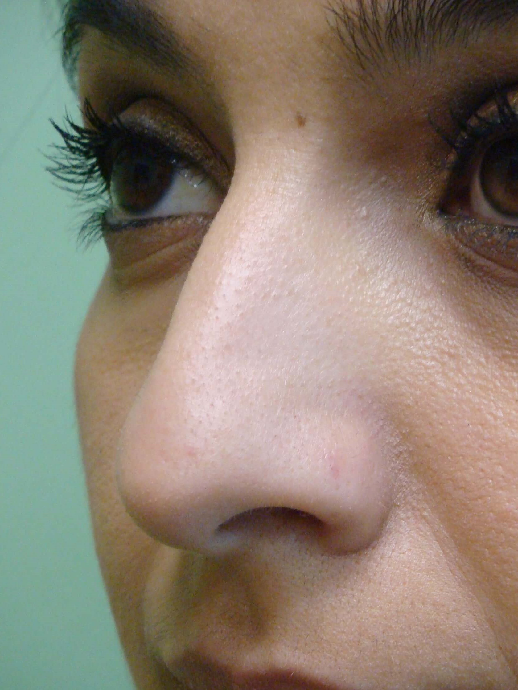 Rhinoplasty (nose job) Before