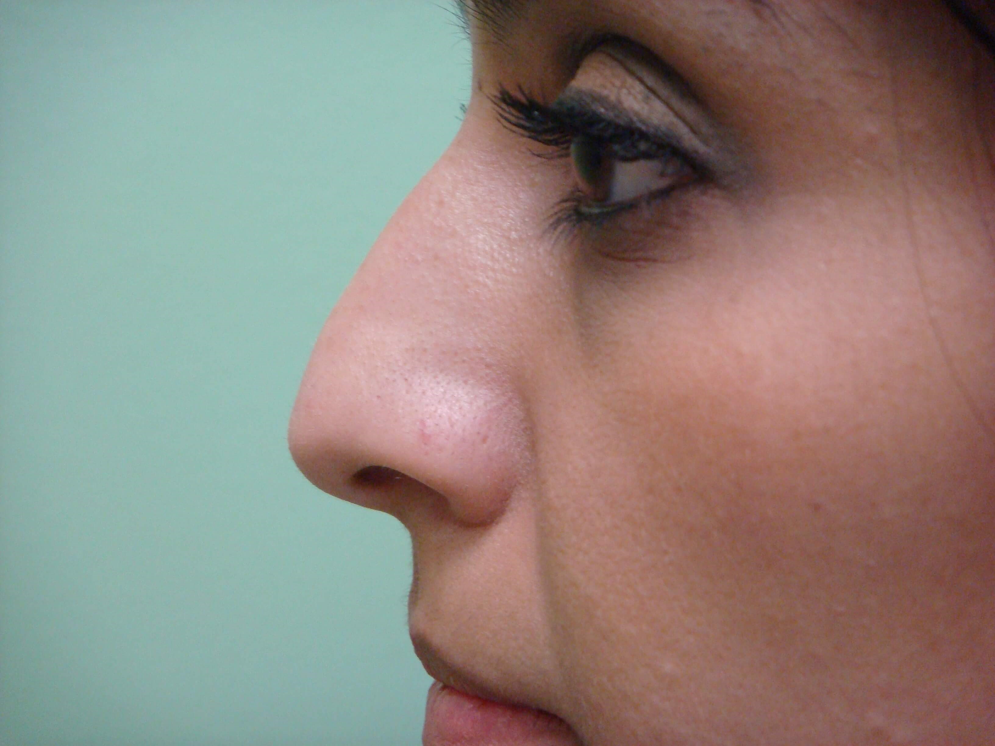 Rhinoplasty (nose job) Before
