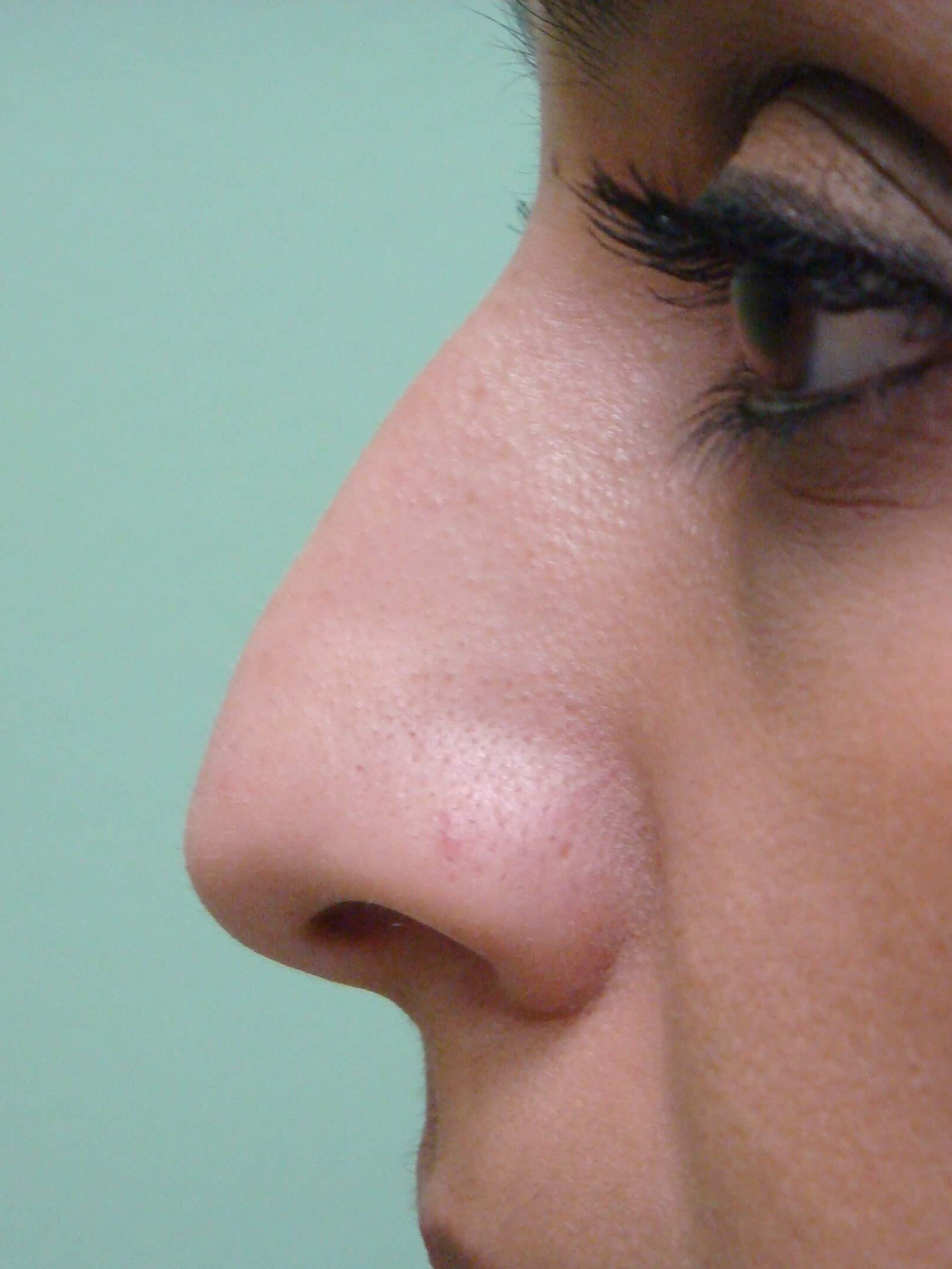 Rhinoplasty (nose job) Before