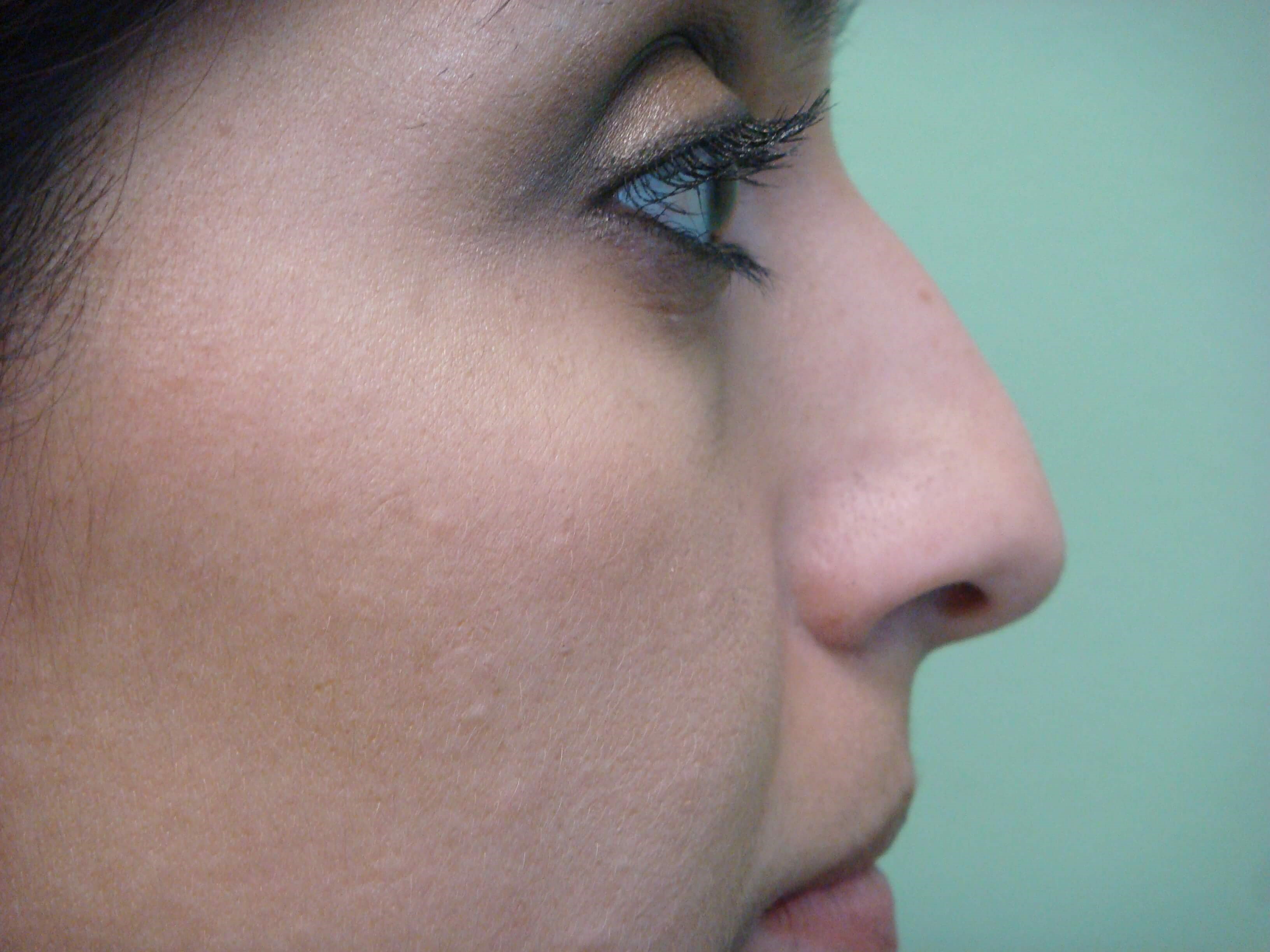 Rhinoplasty (nose job) Before