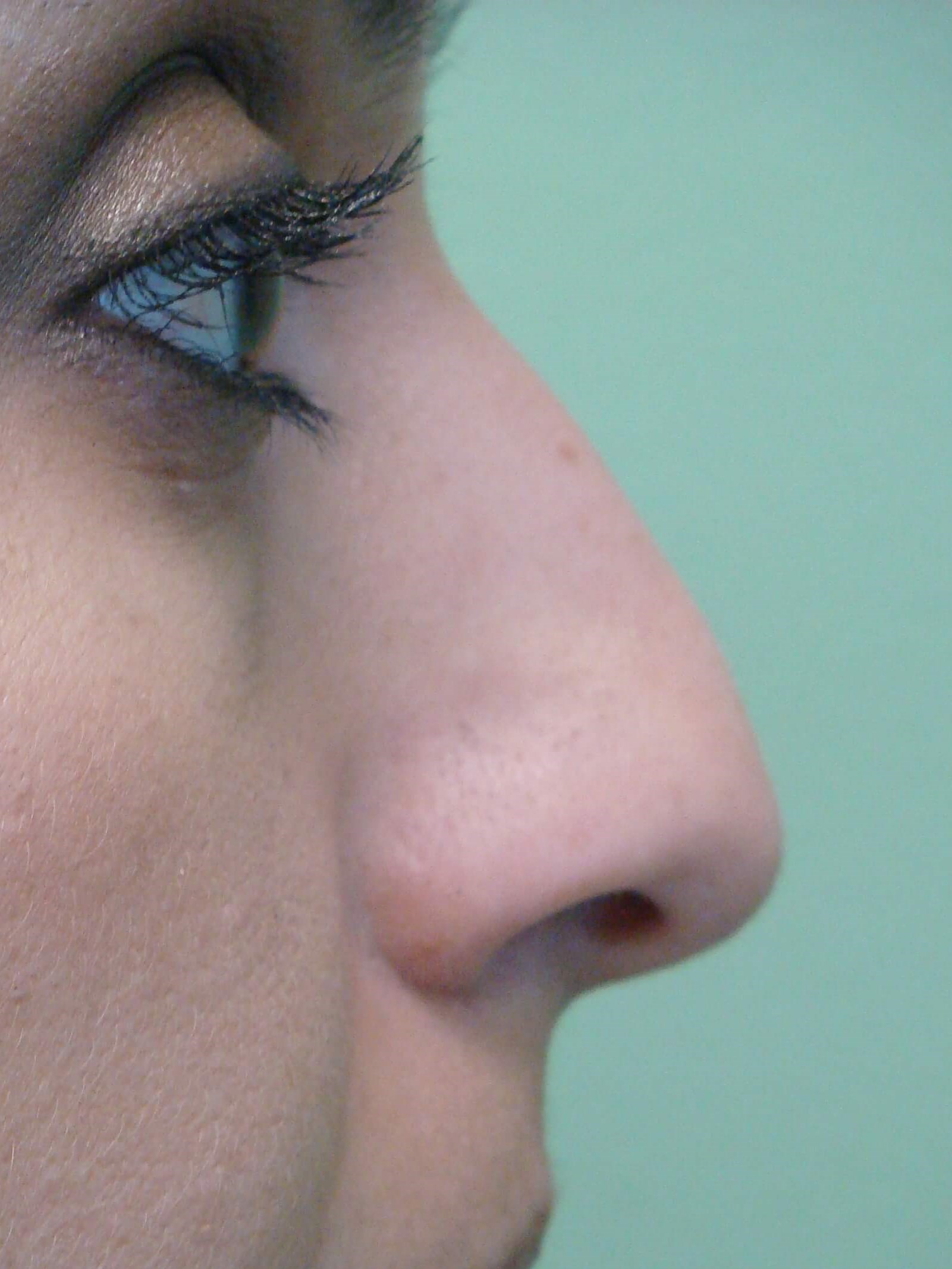Rhinoplasty (nose job) Before