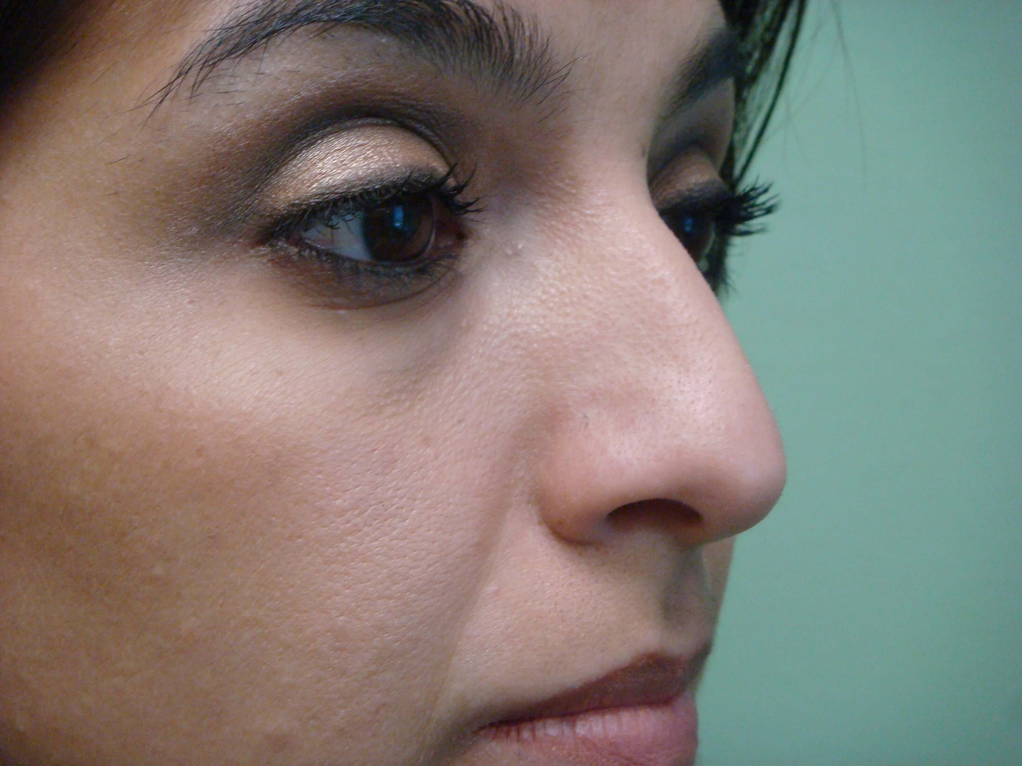 Rhinoplasty (nose job) Before