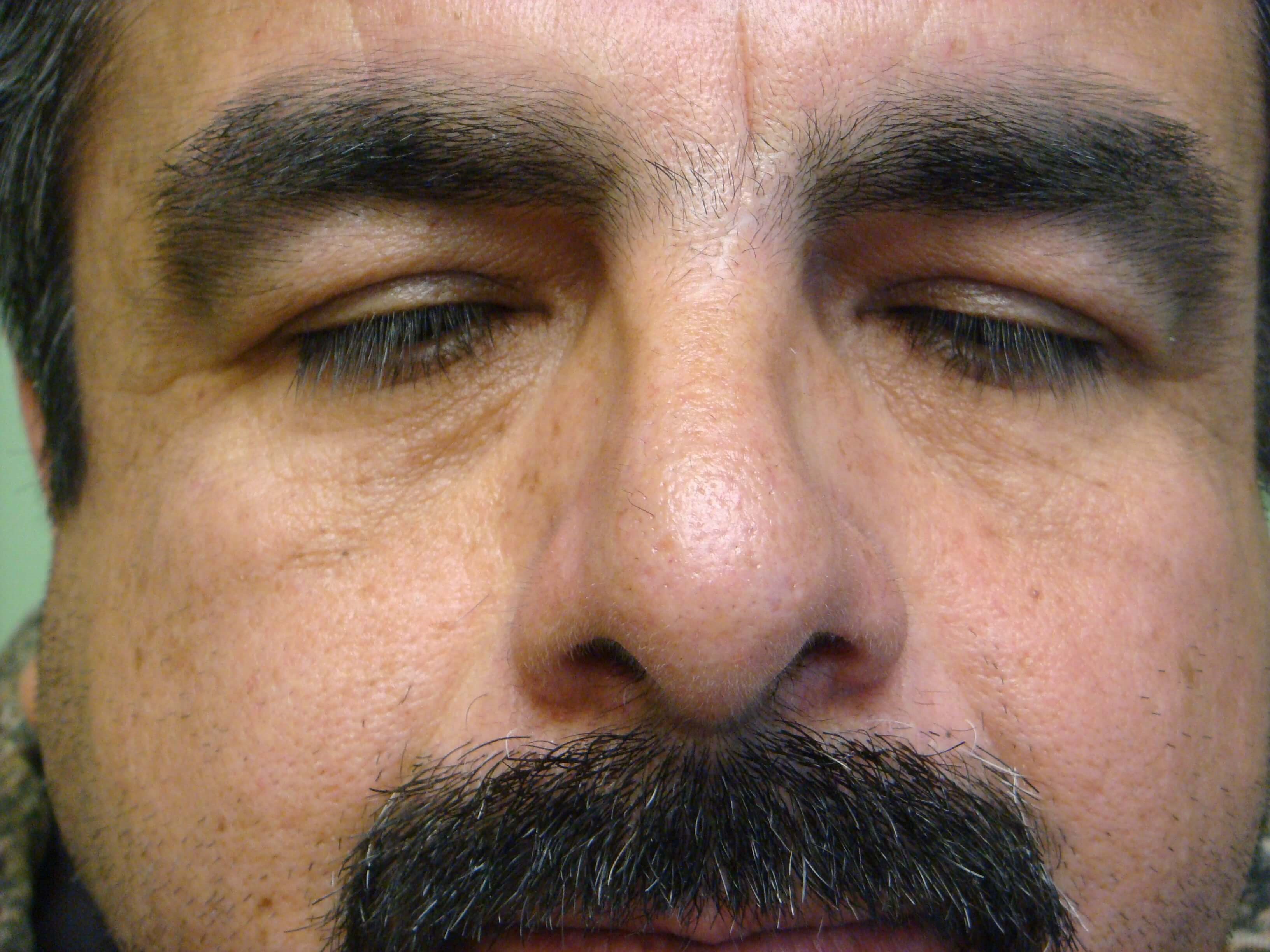 Rhinoplasty/Septoplasty After