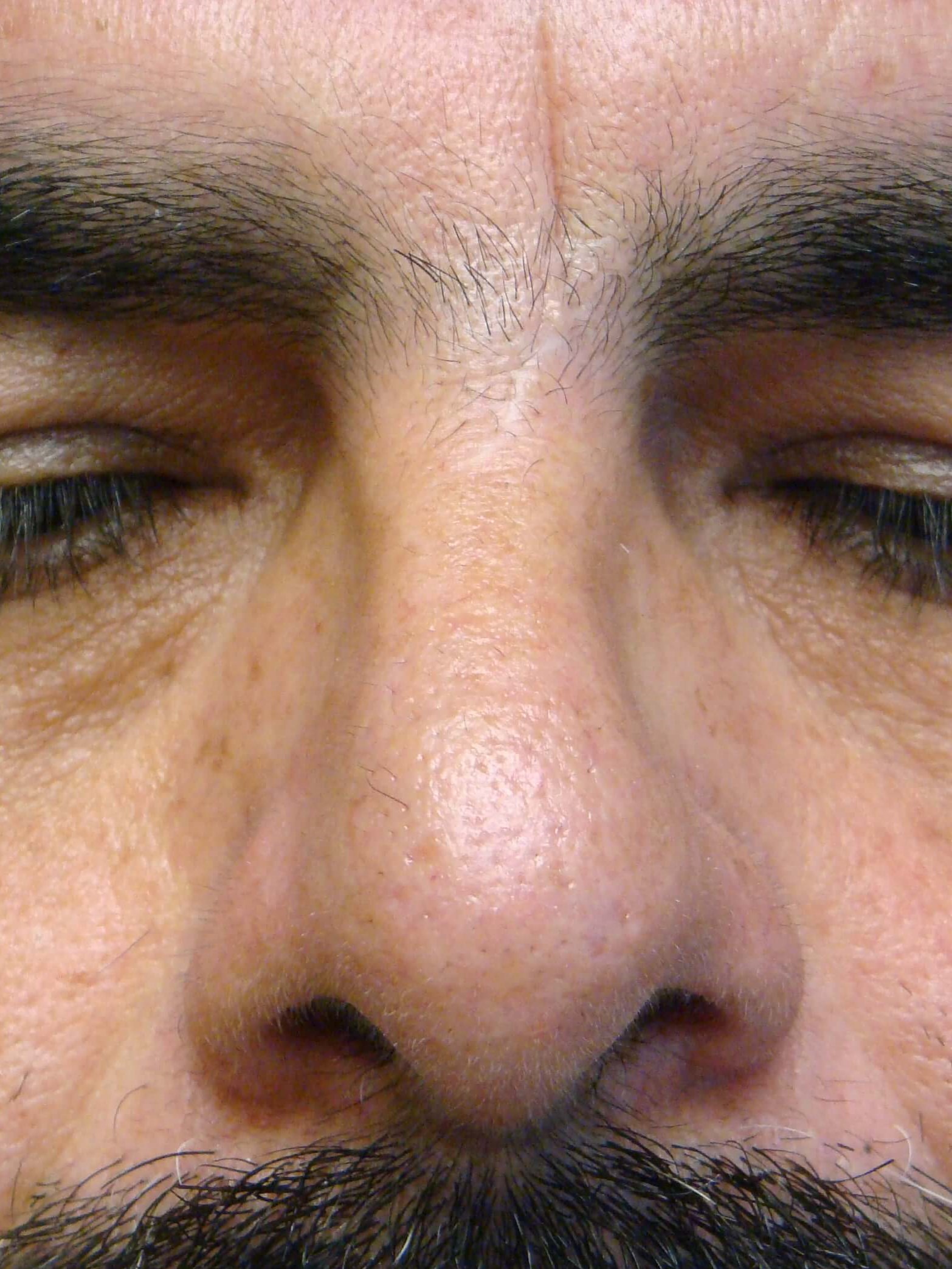 Rhinoplasty/Septoplasty After
