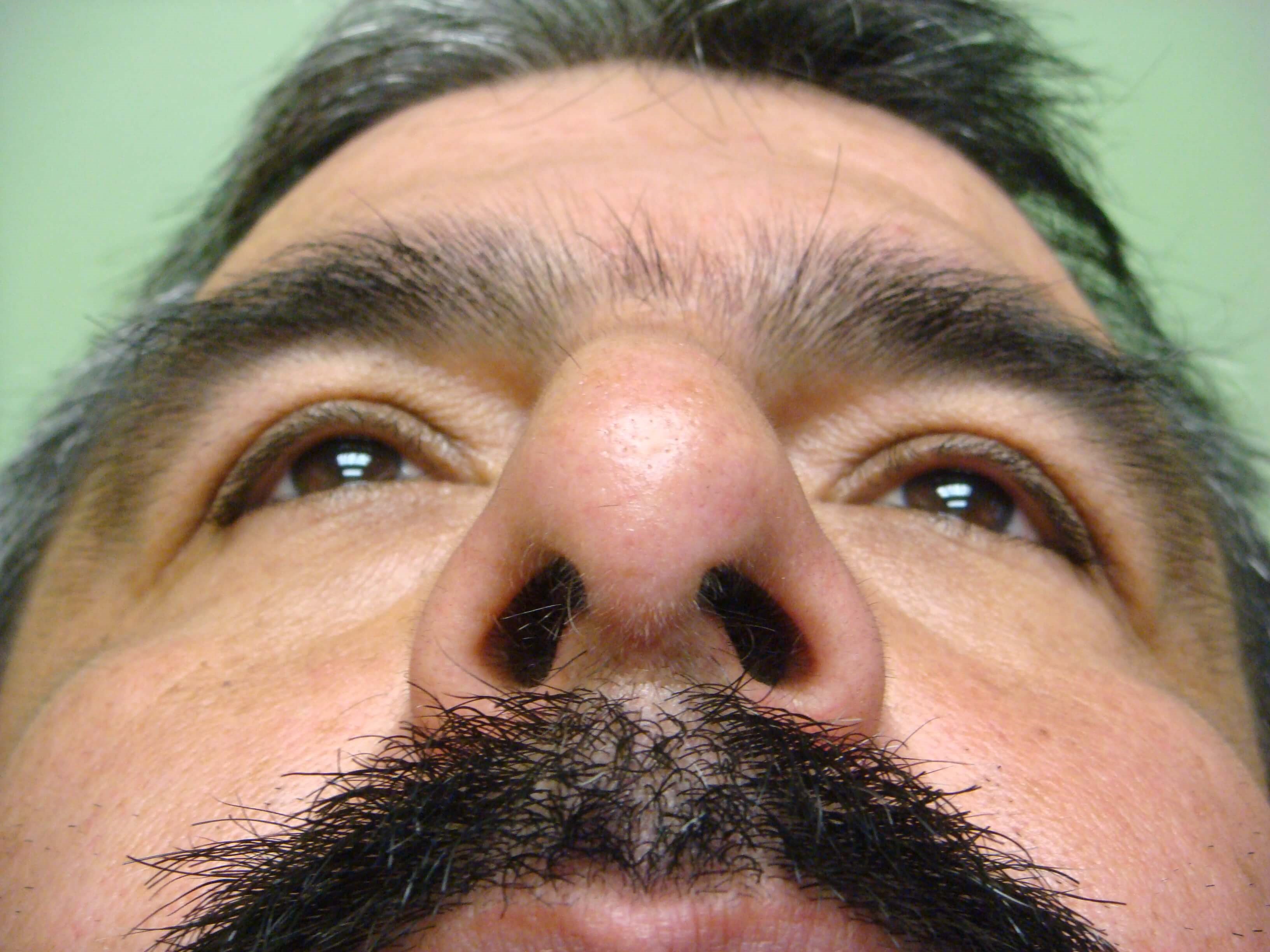 Rhinoplasty/Septoplasty After