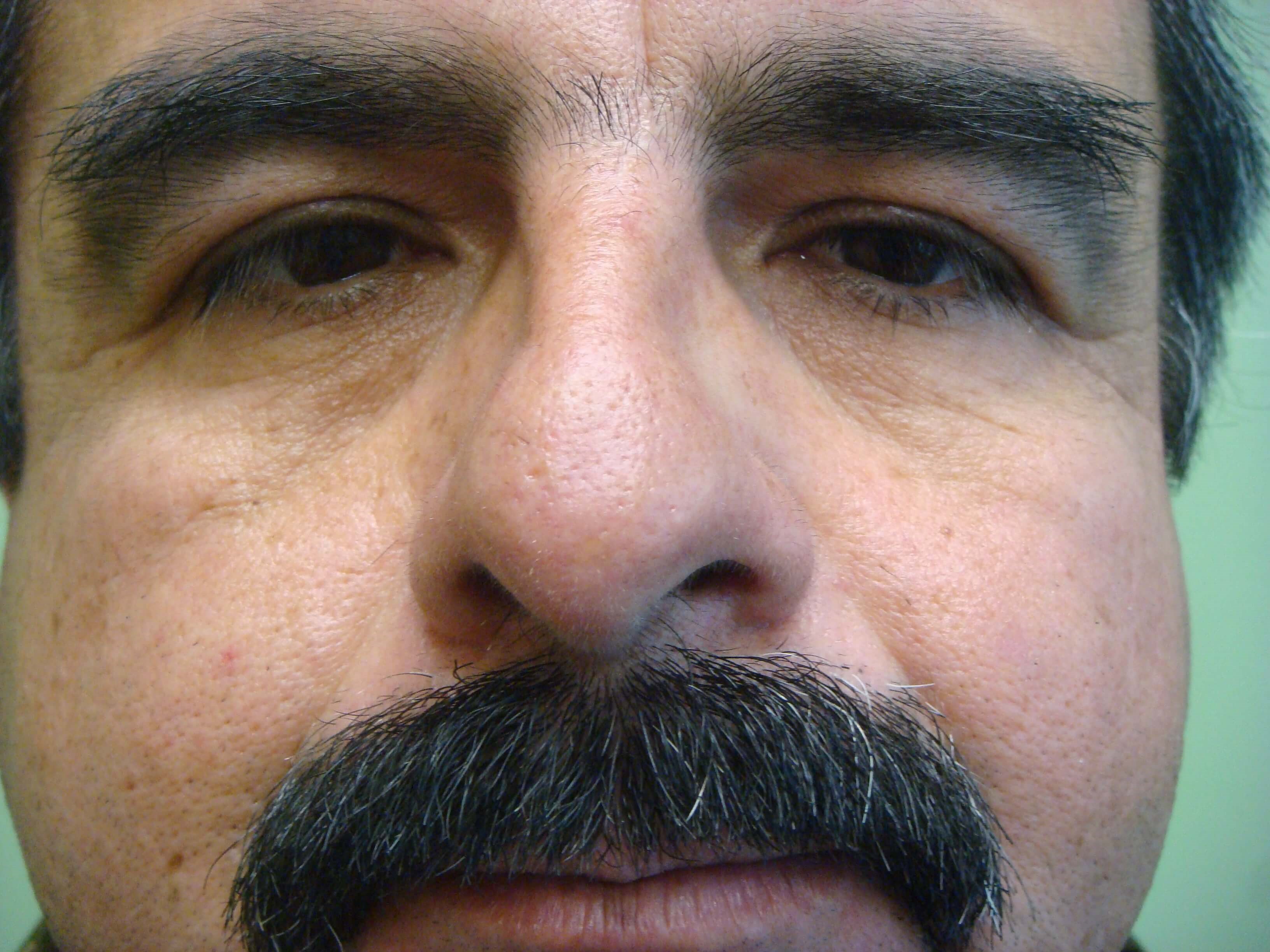 Rhinoplasty/Septoplasty Before