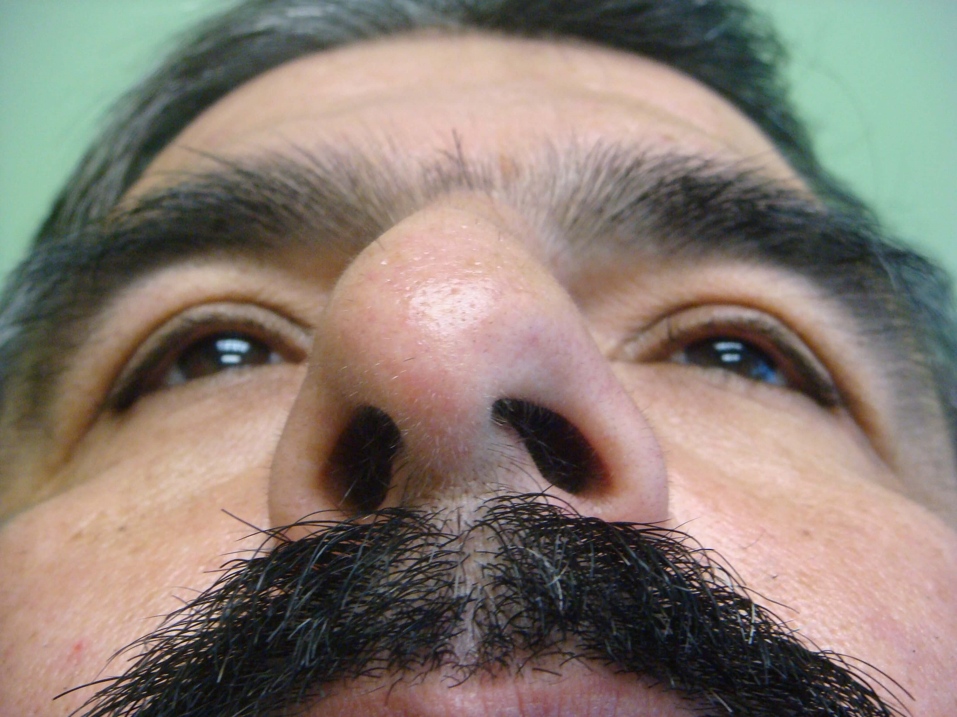 Rhinoplasty/Septoplasty Before