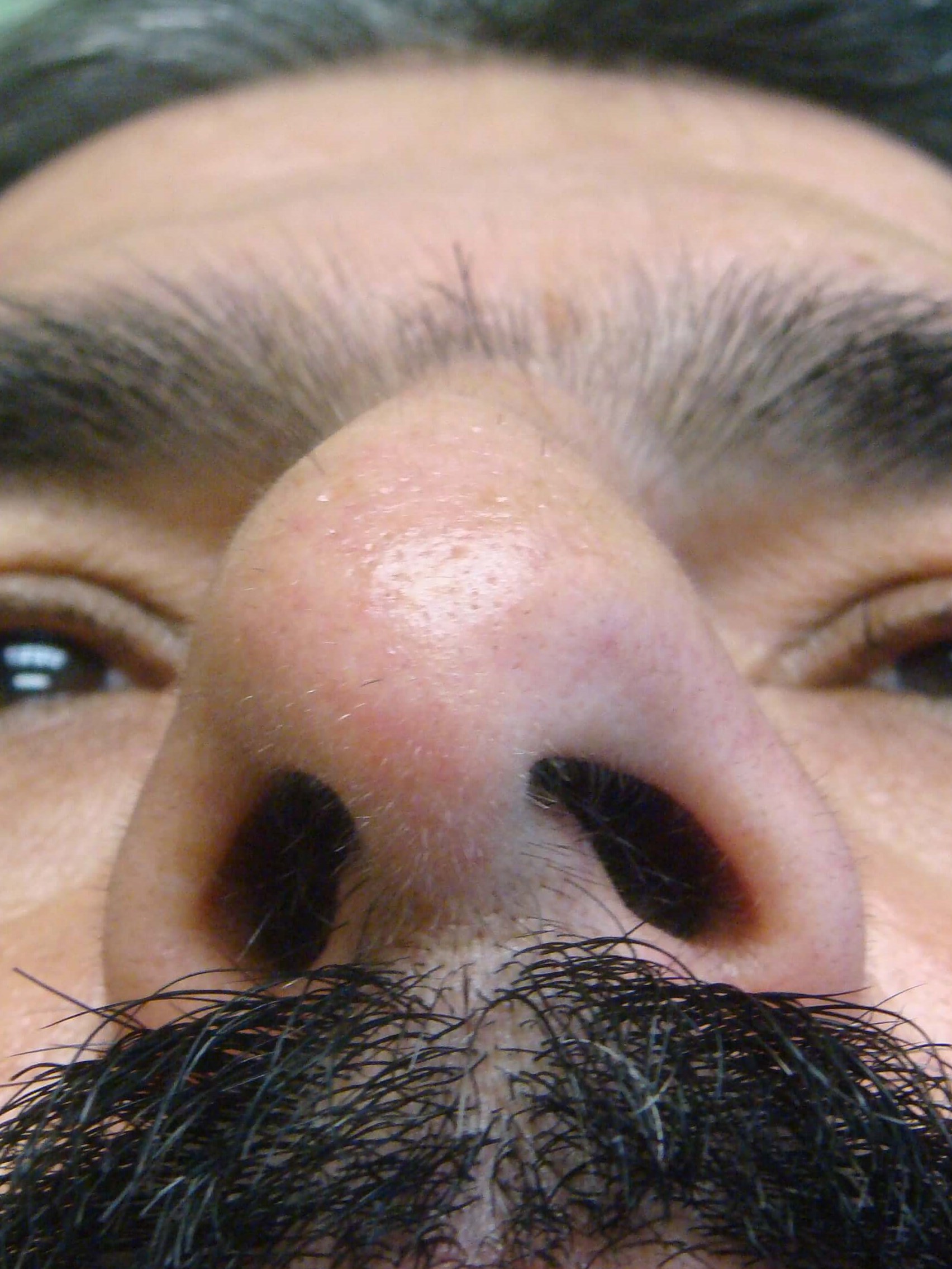Rhinoplasty/Septoplasty Before