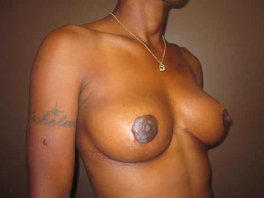 Mastopexy (Breast Lift) After
