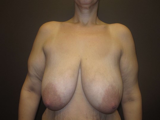 Mastopexy (Breast Lift) Before