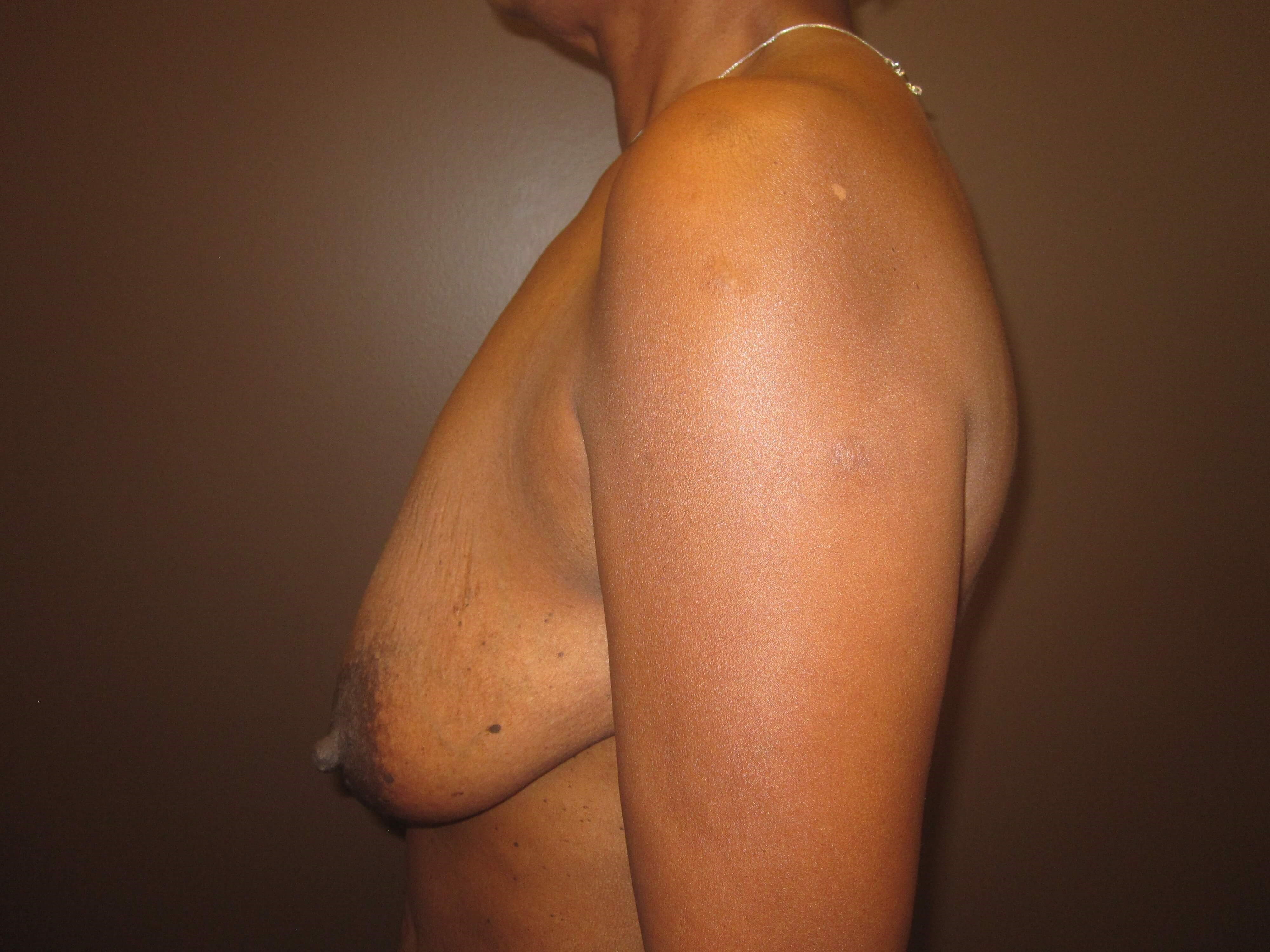 Mastopexy (Breast Lift) Before