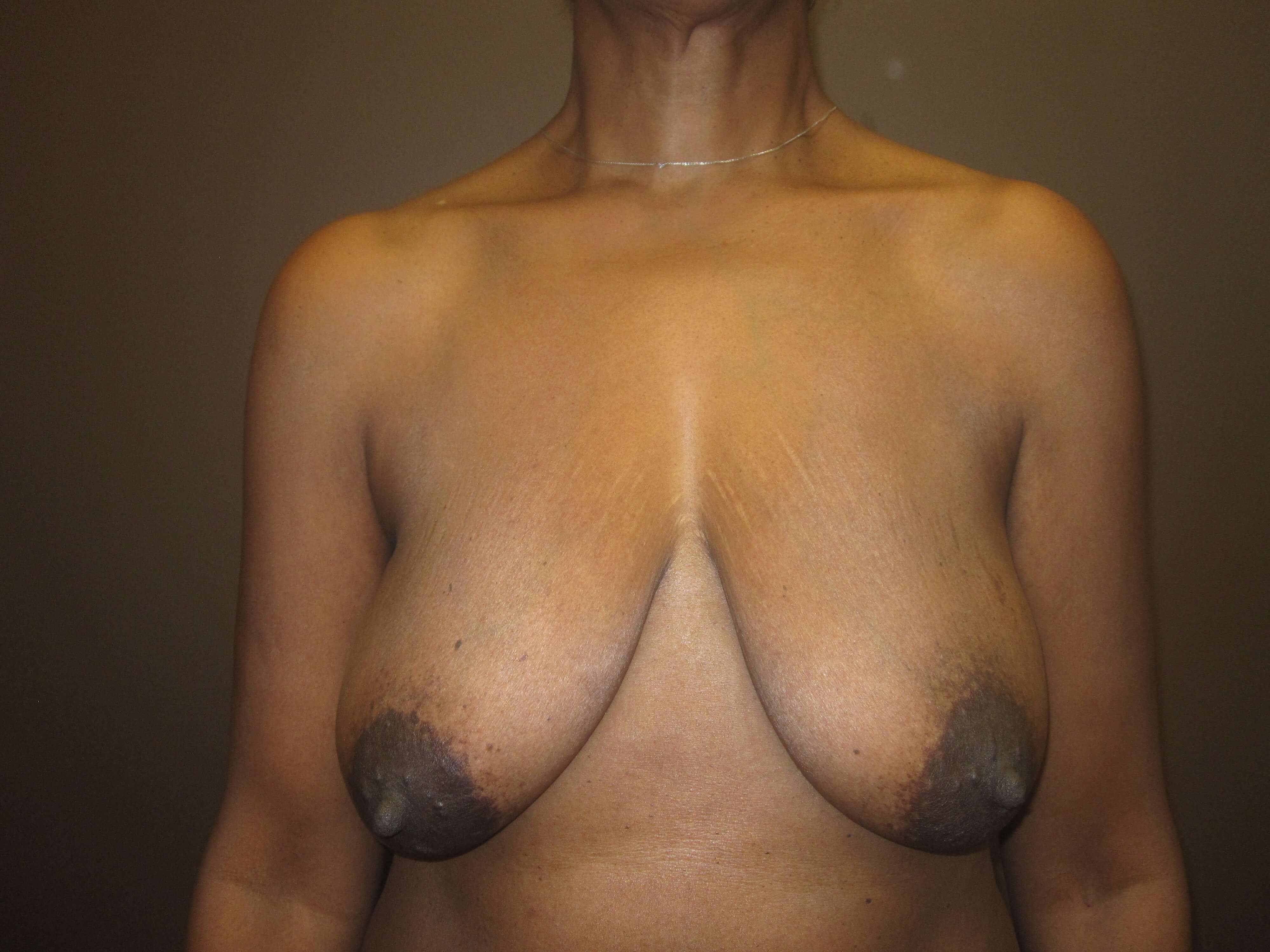 Mastopexy (Breast Lift) Before