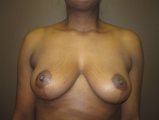 Mastopexy (Breast Lift) After