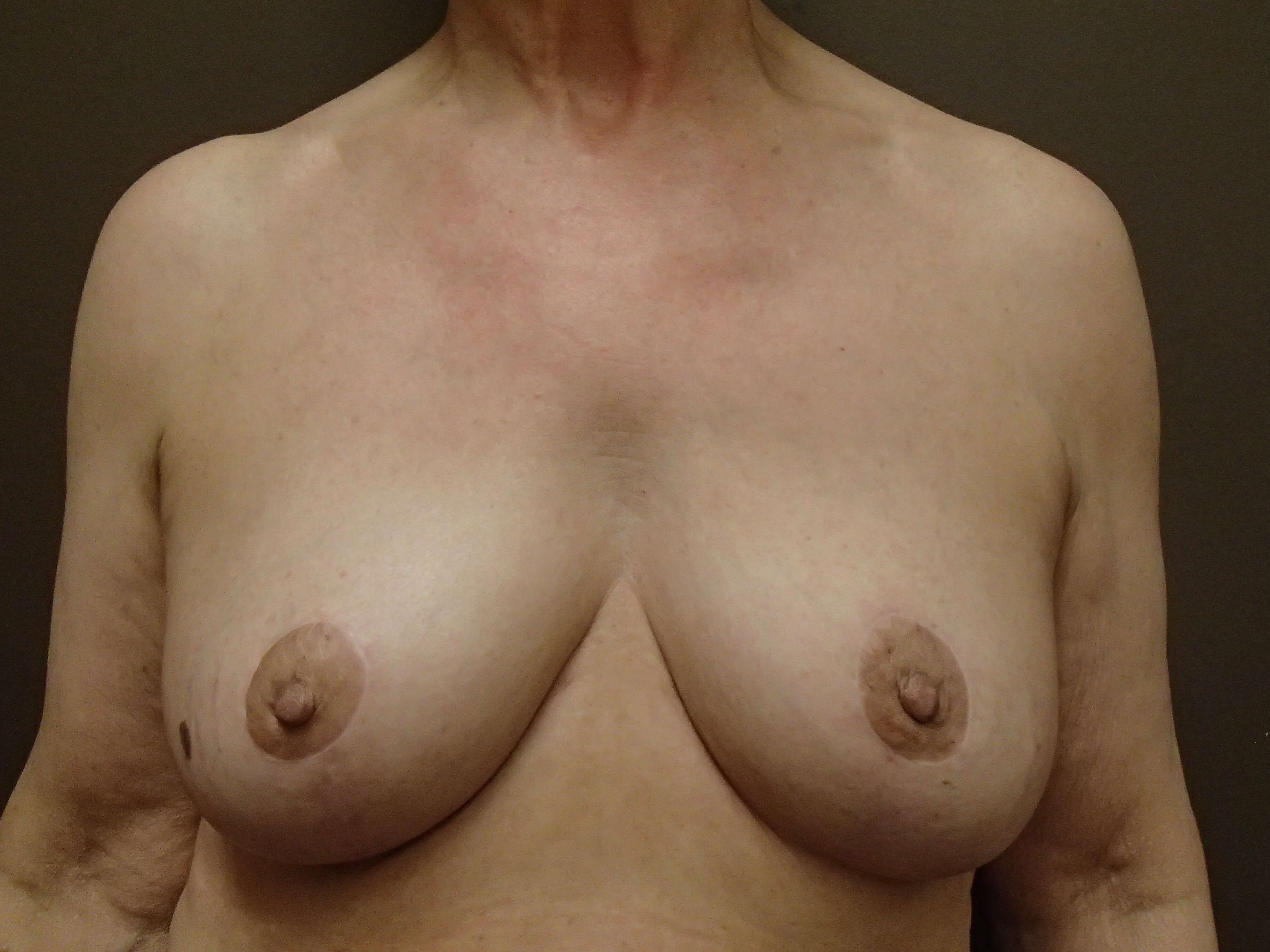Breast Explant and Mastopexy After