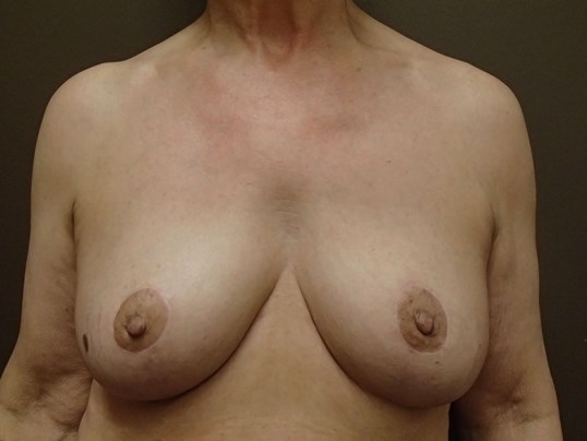 Breast Explant and Mastopexy After