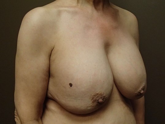 Breast Explant and Mastopexy Before