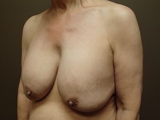 Breast Explant and Mastopexy Before