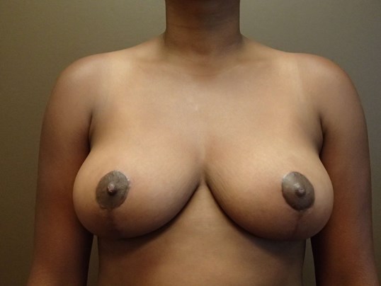 Mastopexy (Breast Lift) After