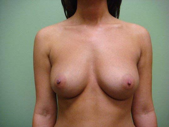 Breast Augmentation Front Before