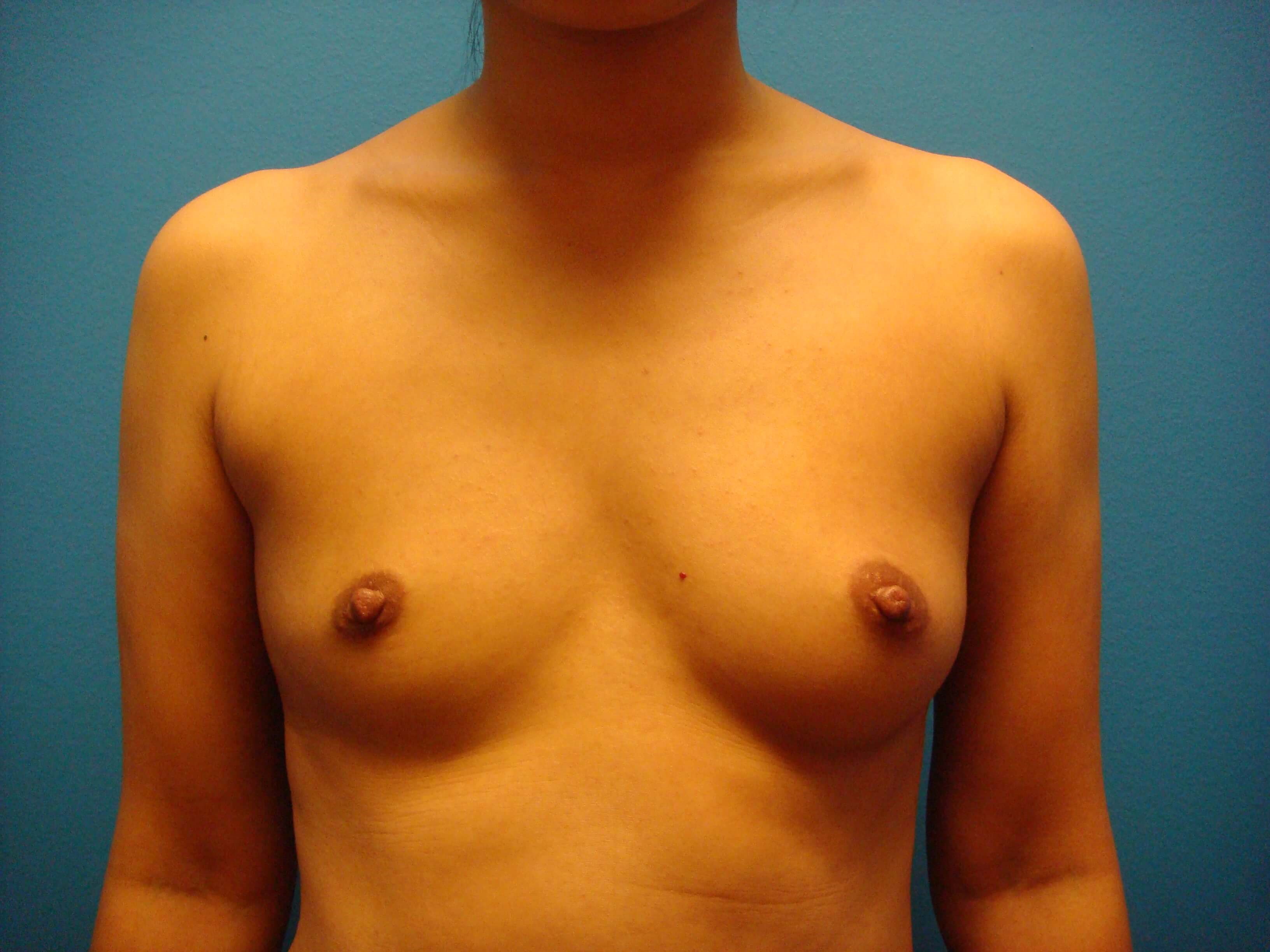 Breast Augmentation Front Before