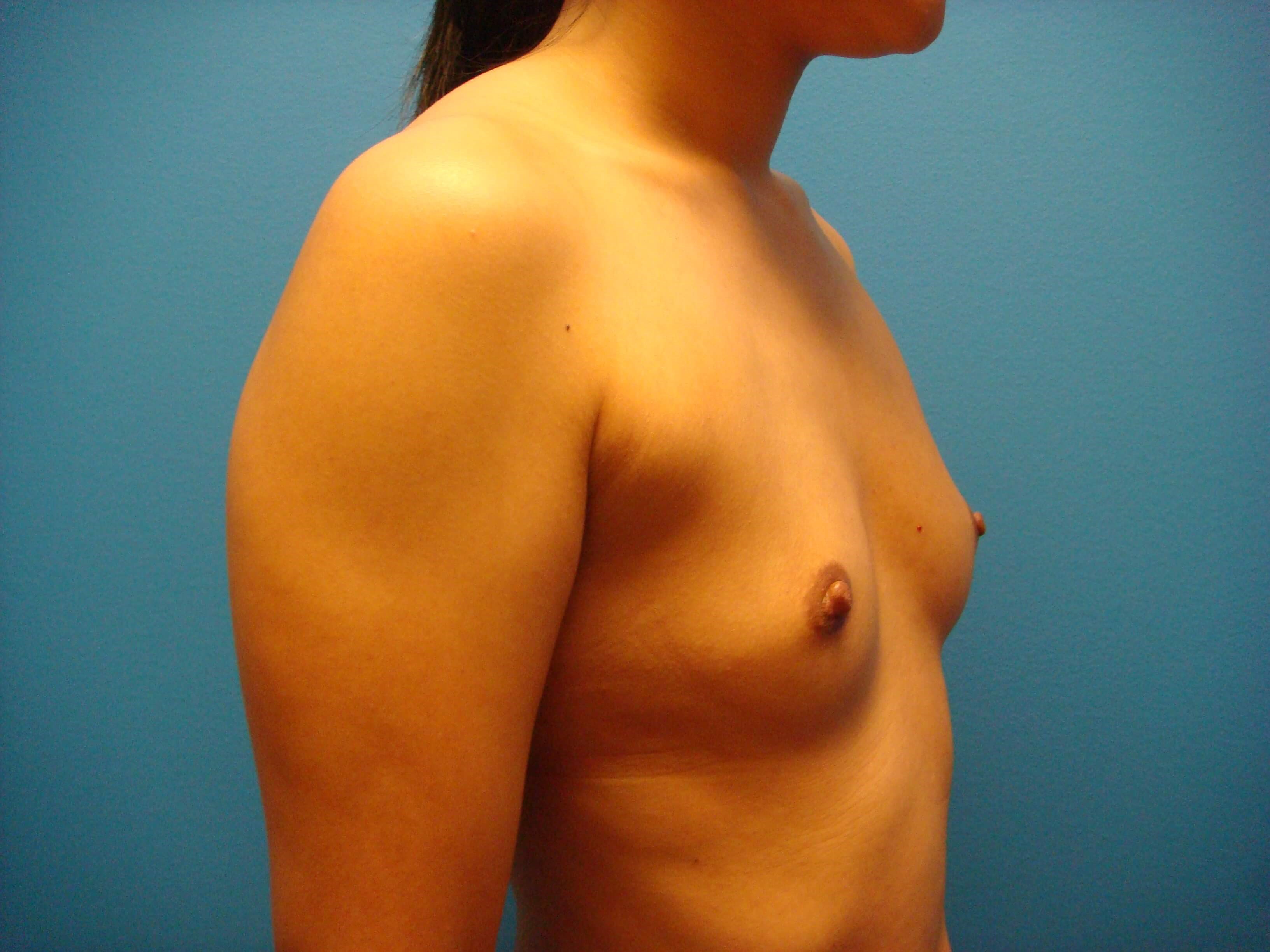 Breast Augmentation Oblique Before